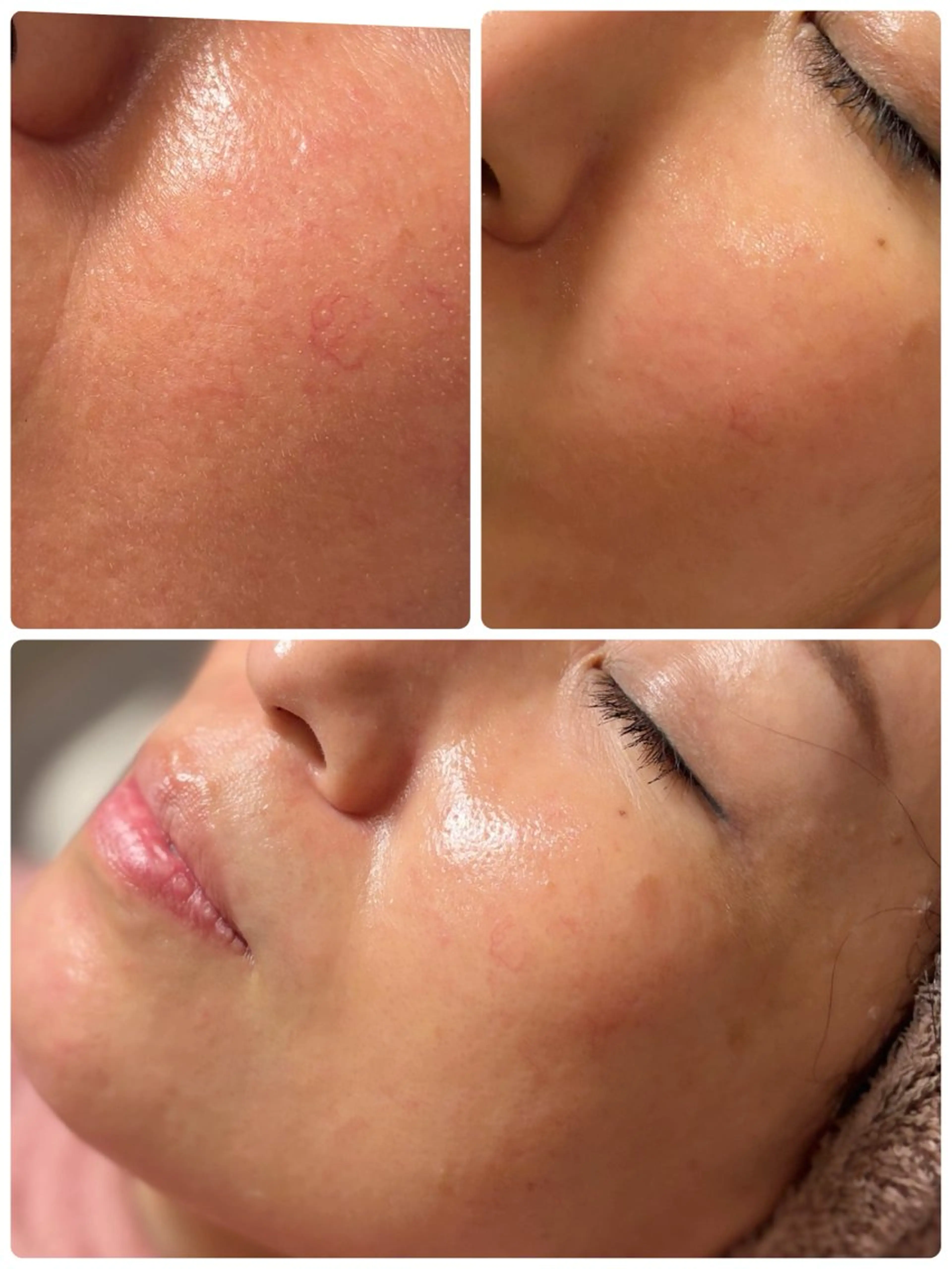 極上美肌リセットコースの写真