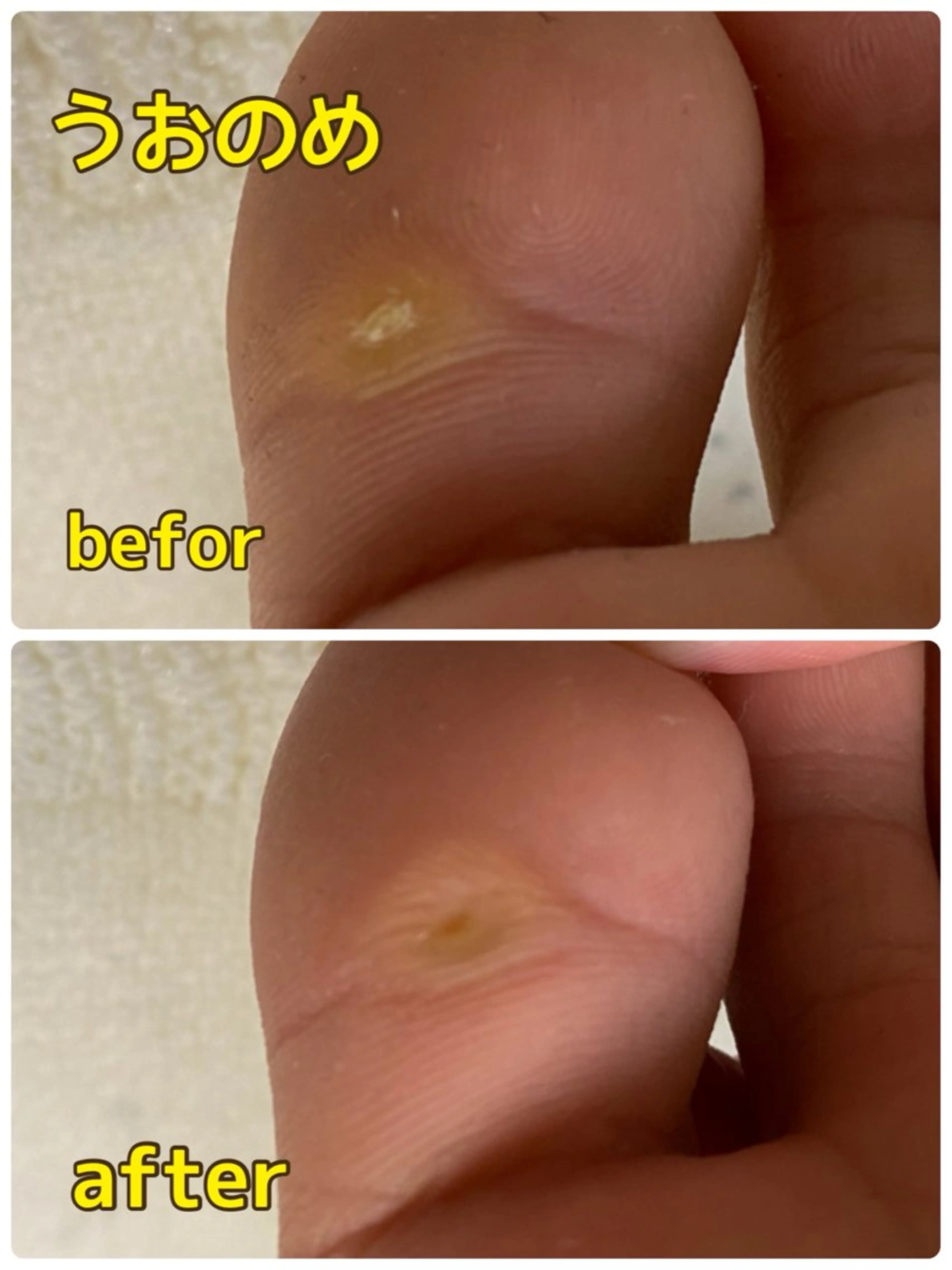 【大人気メニュー】魚の目取り放題コース♪（隠れた魚の目まで綺麗に取らせていただきます）の写真