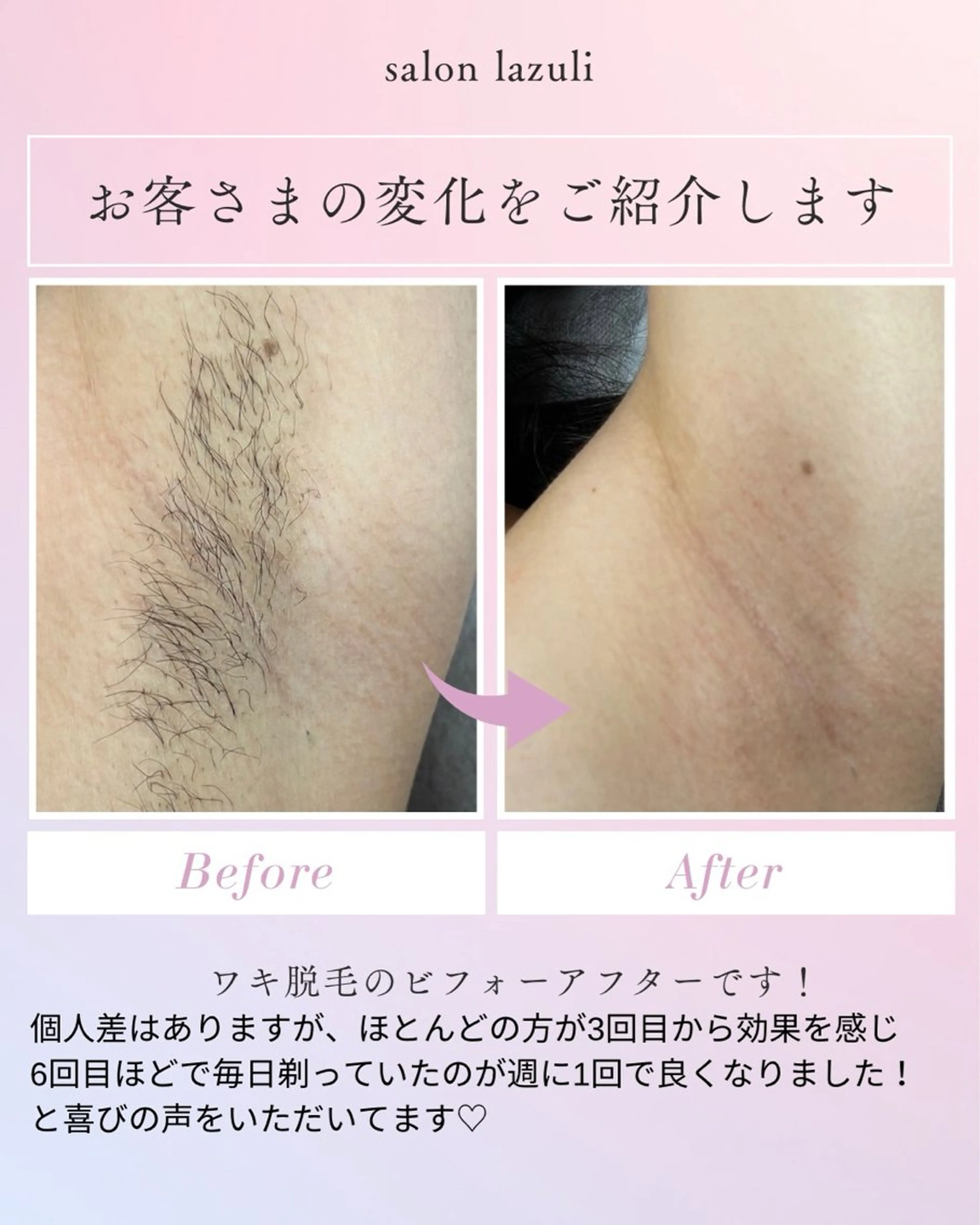 脱毛 野中 起子のエステ・リラクイメージ