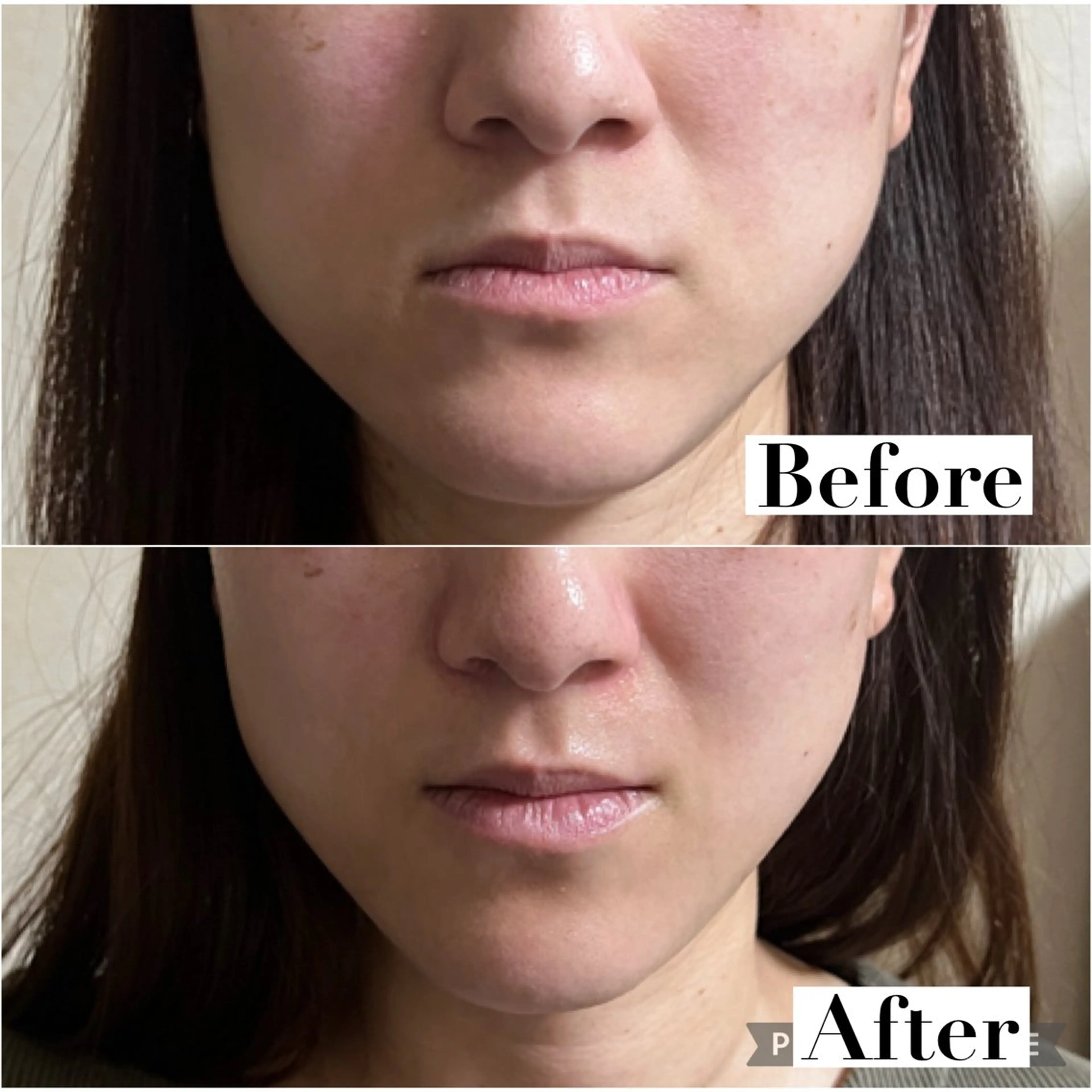 エラハリ・食いしばり集中ケア【肌ケア付】の写真