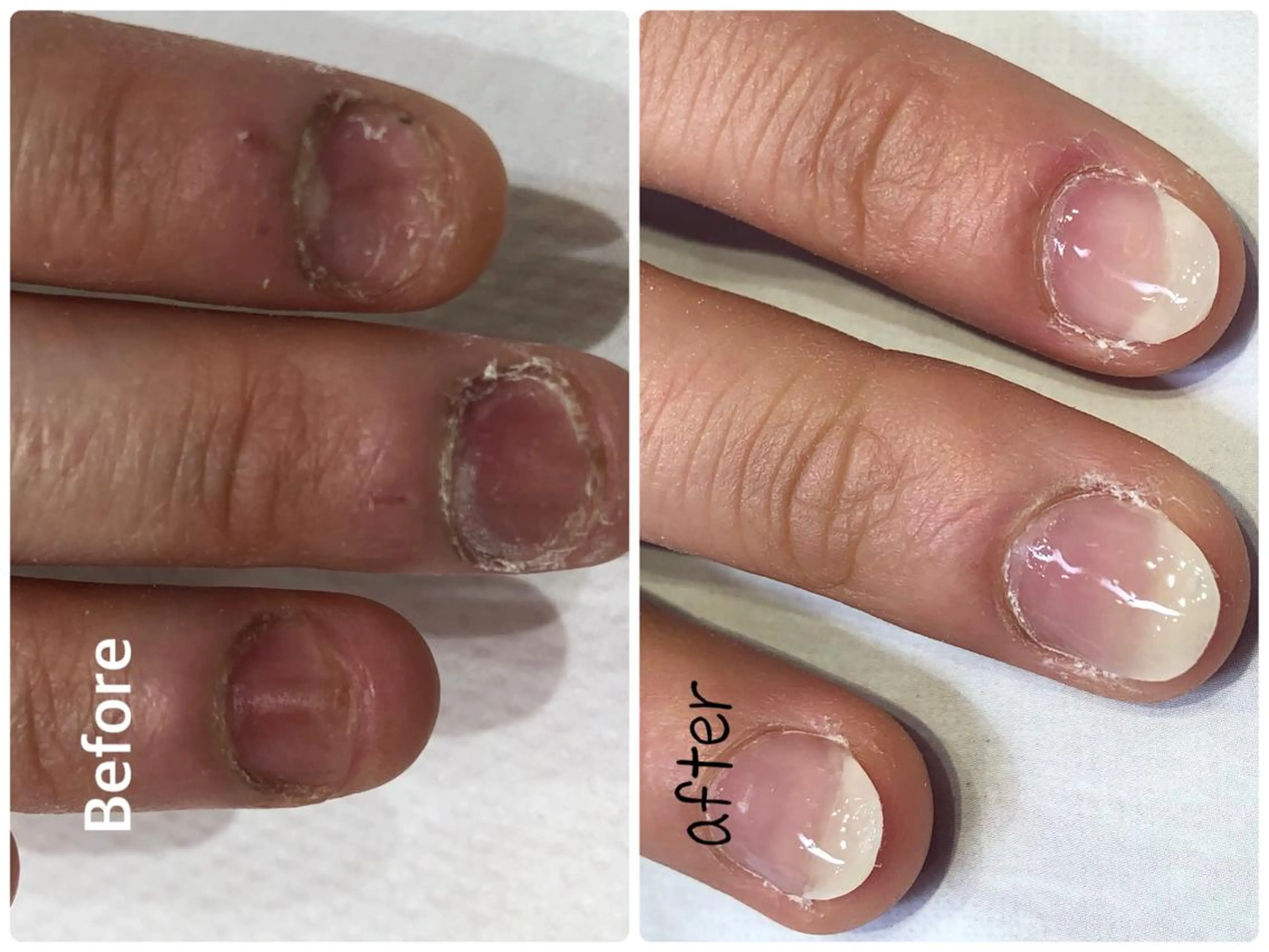 ネイル グレースレディ所属・深爪矯正長さ出し専門 グレースレディのネイルデザイン