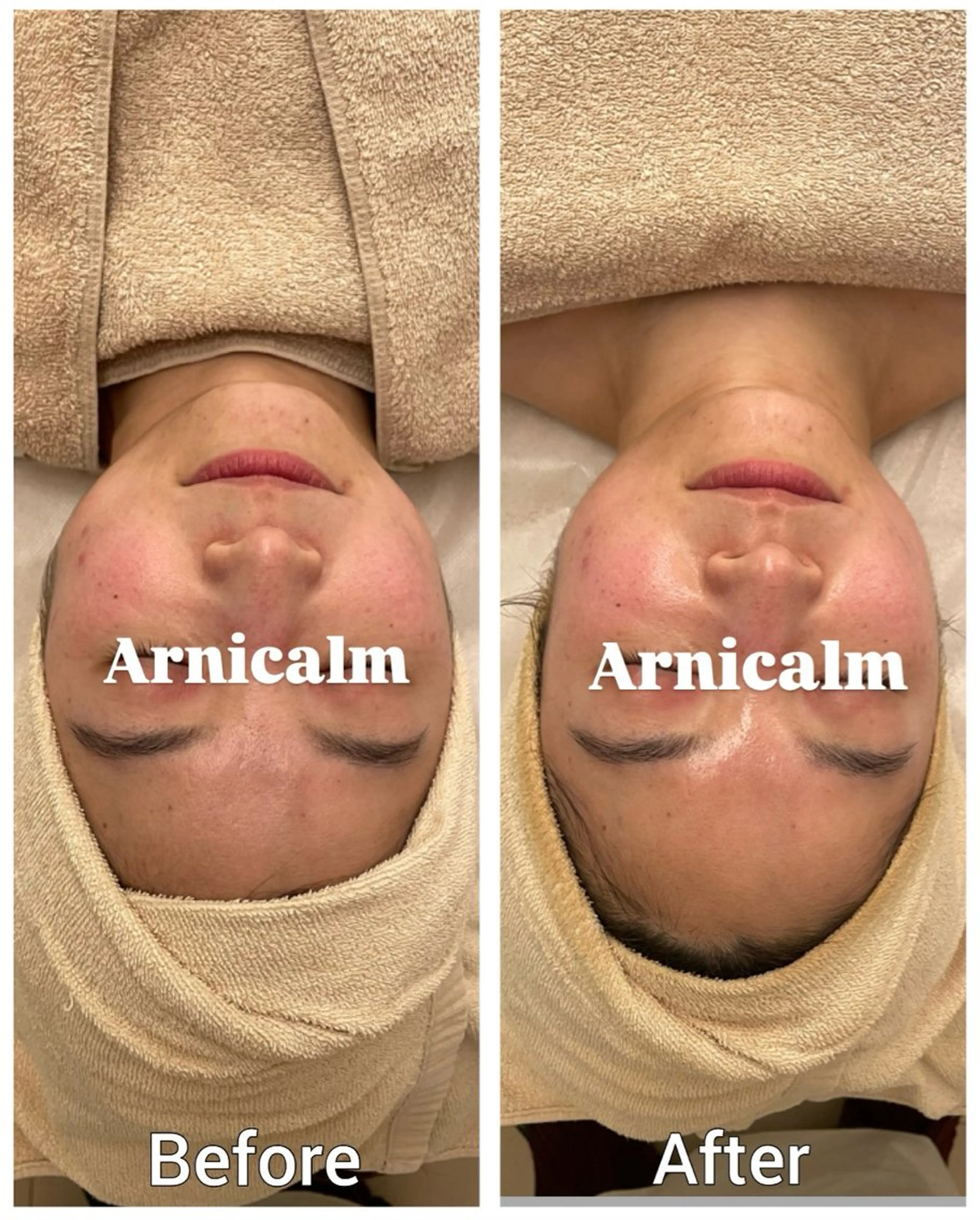 ハーブピーリング 肌再生ピーリング/のエステ・リラクイメージ