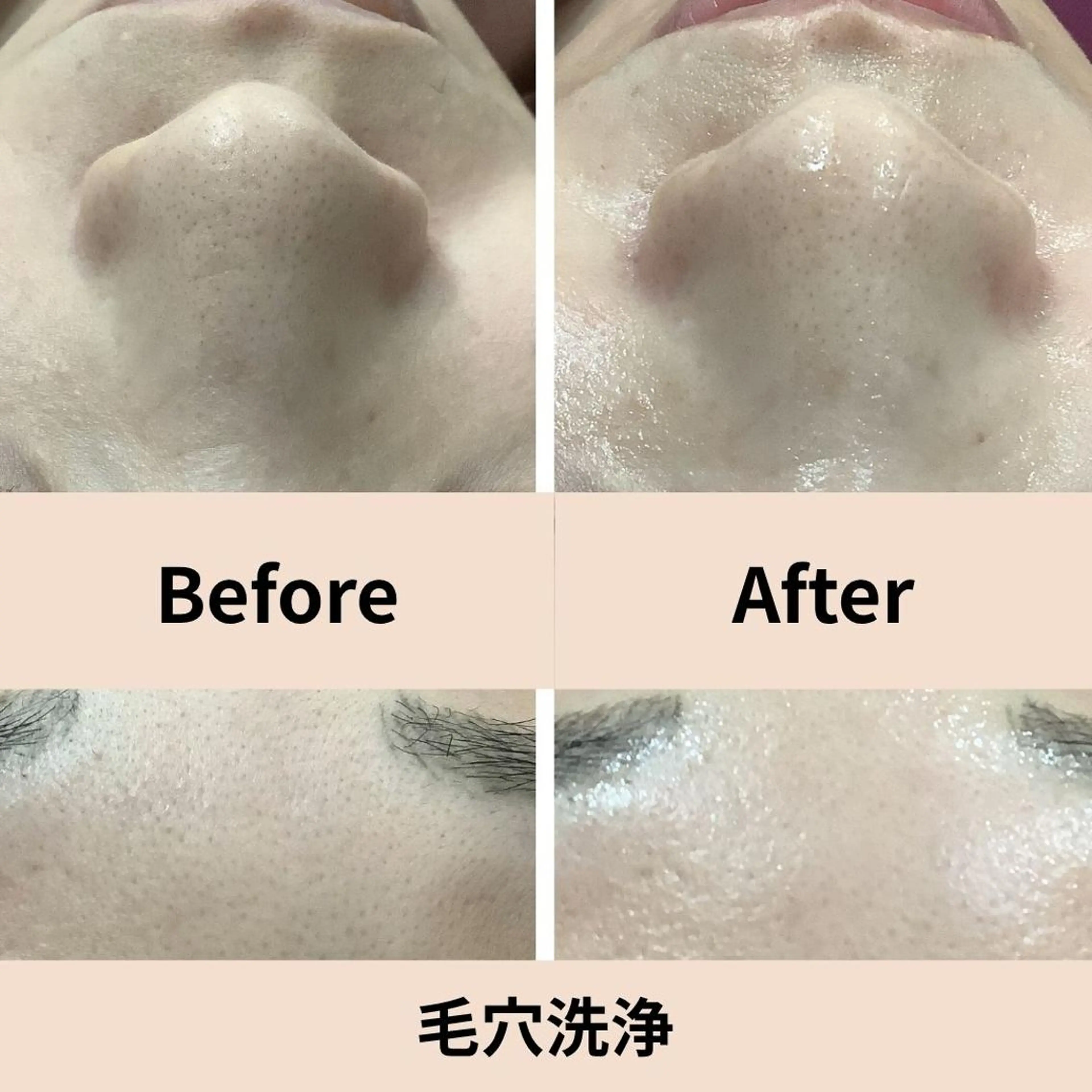 【黒ずみ/ざらつき/皮脂過多】毛穴すっきり洗浄＋保湿ケアの写真