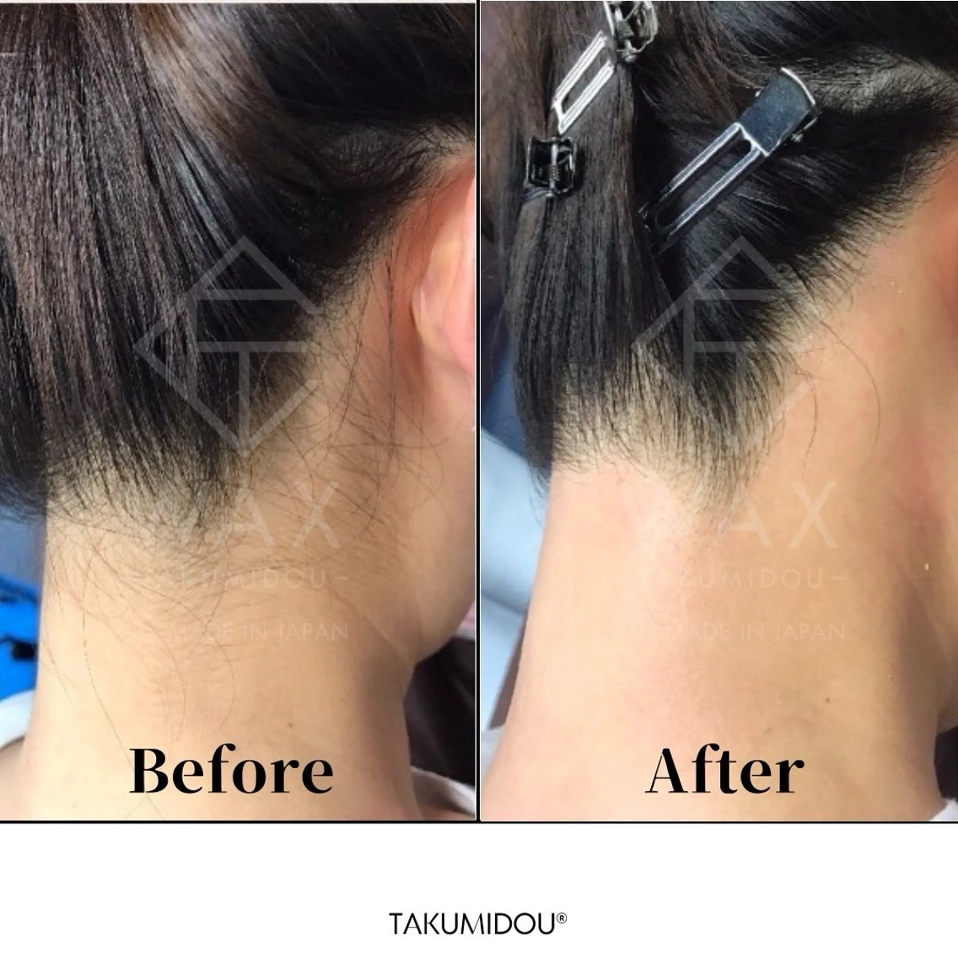 フェイシャルWax脱毛＋うなじWax脱毛🧡夏に向けてムダ毛ケア✨✨の写真