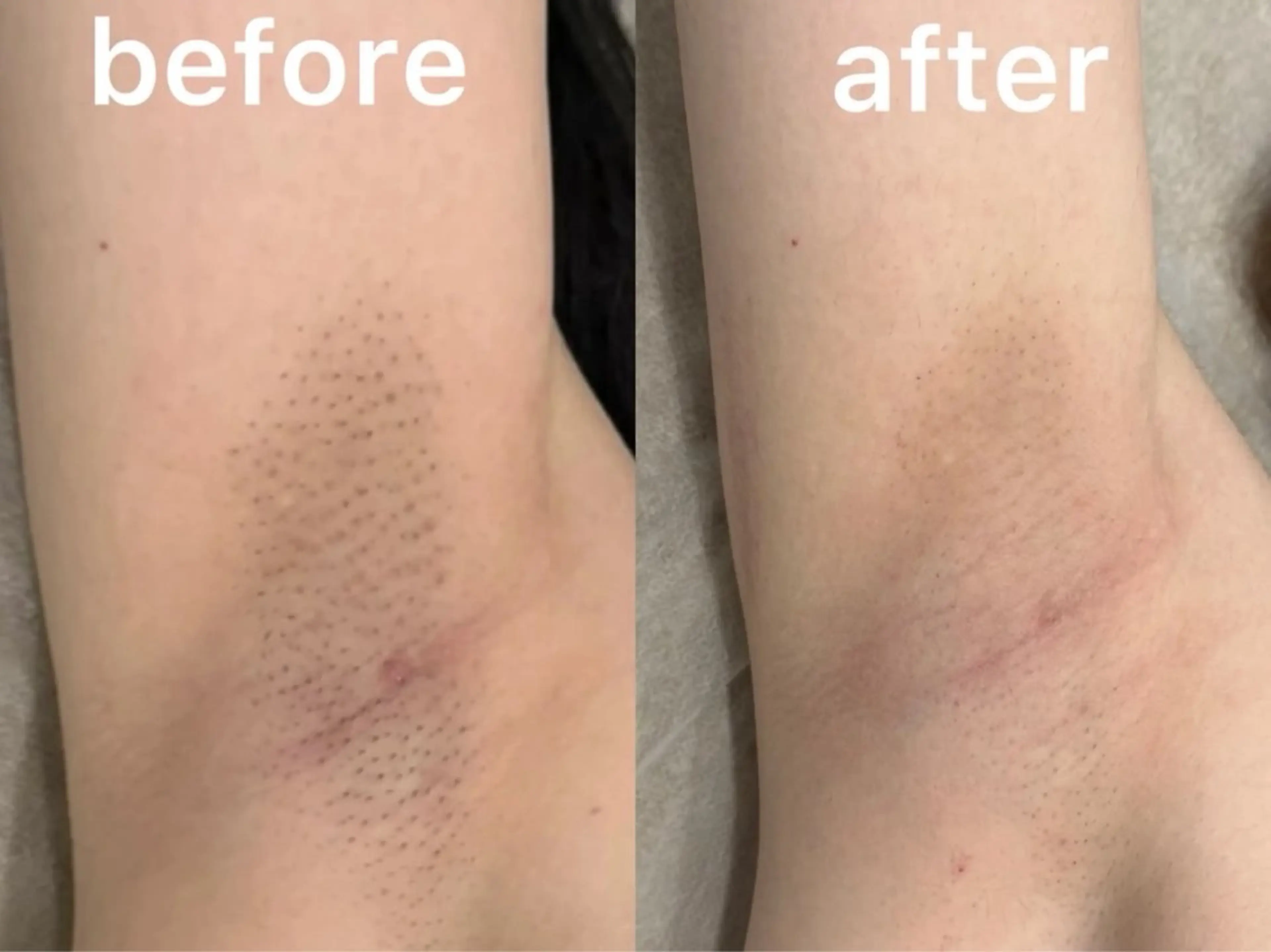 VIO /美肌専門サロン【Beauty salon Bibiy】所属・VIO美肌専門サロン Bibiyのエステ・リラクイメージ