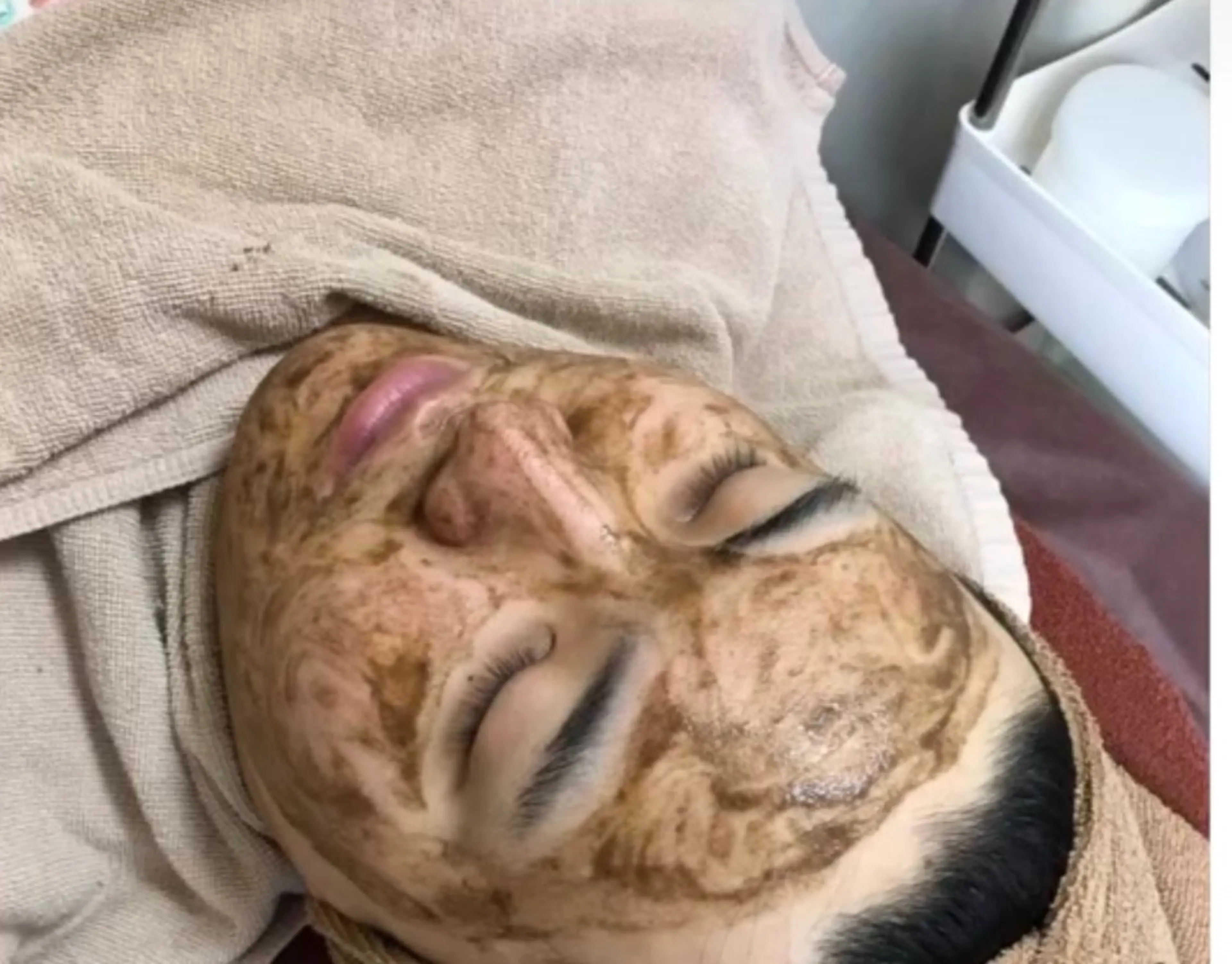 頑固な毛穴つまり◎ハイドラ＋ノーズクレンジング＋ハーブピーリング✨セット💕🌿毛穴の汚れ　毛穴黒ずみ　ニキビ　ニキビ跡の写真