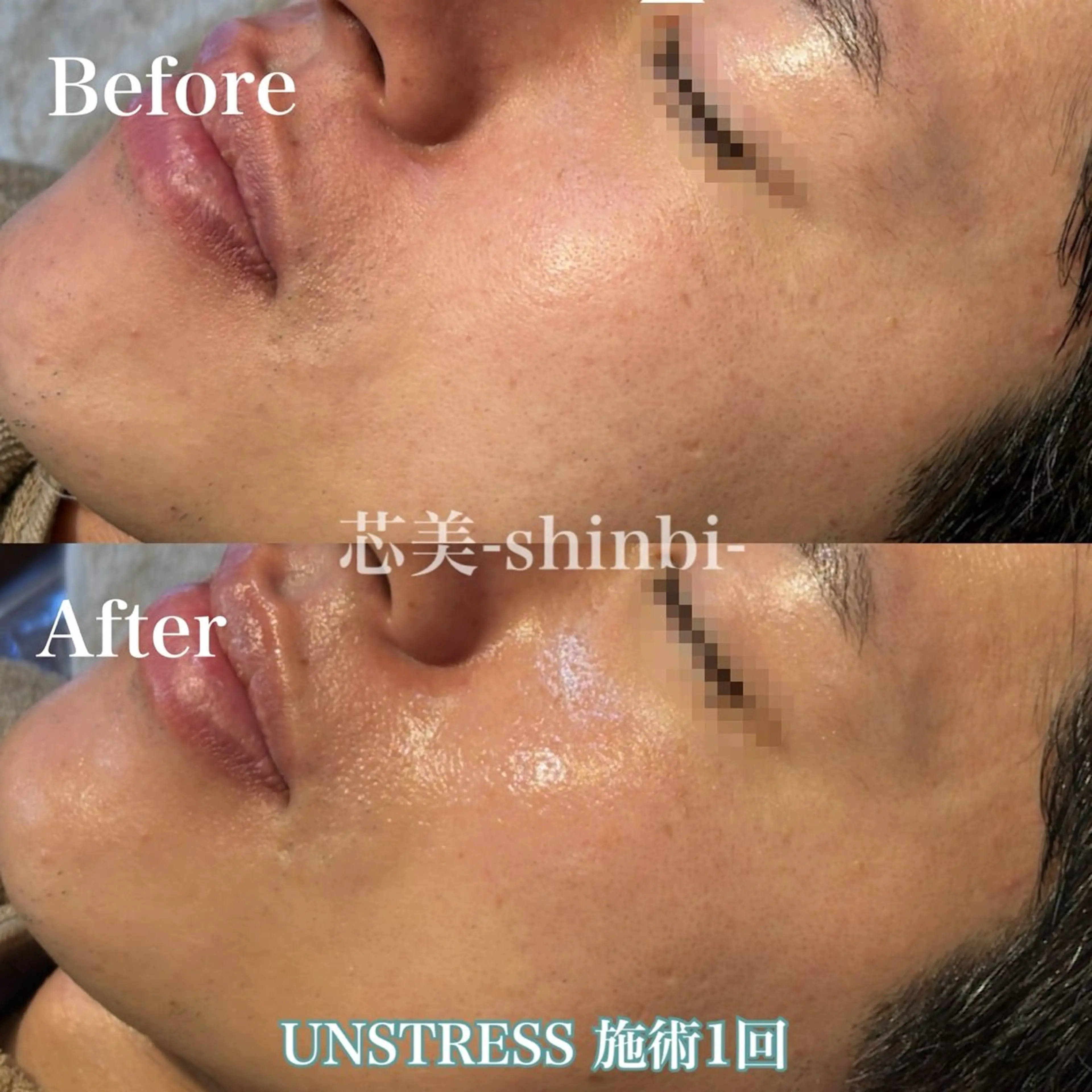 芯美-shinbi-所属・毛穴・ニキビケア ￤肌質改善￤EMIのエステ・リラクイメージ