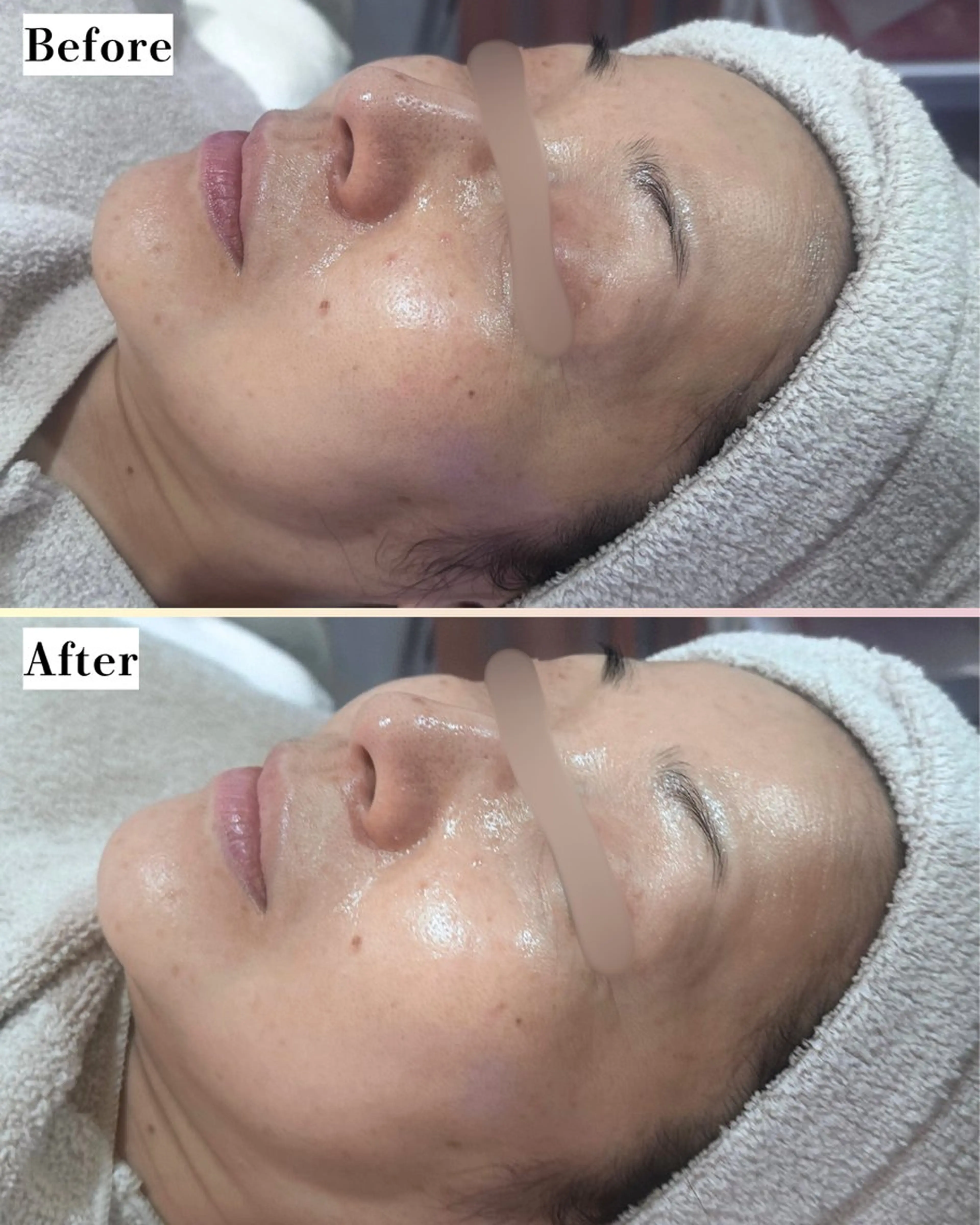 エステ |ピーリング・毛穴| soina神楽坂のエステ・リラクイメージ