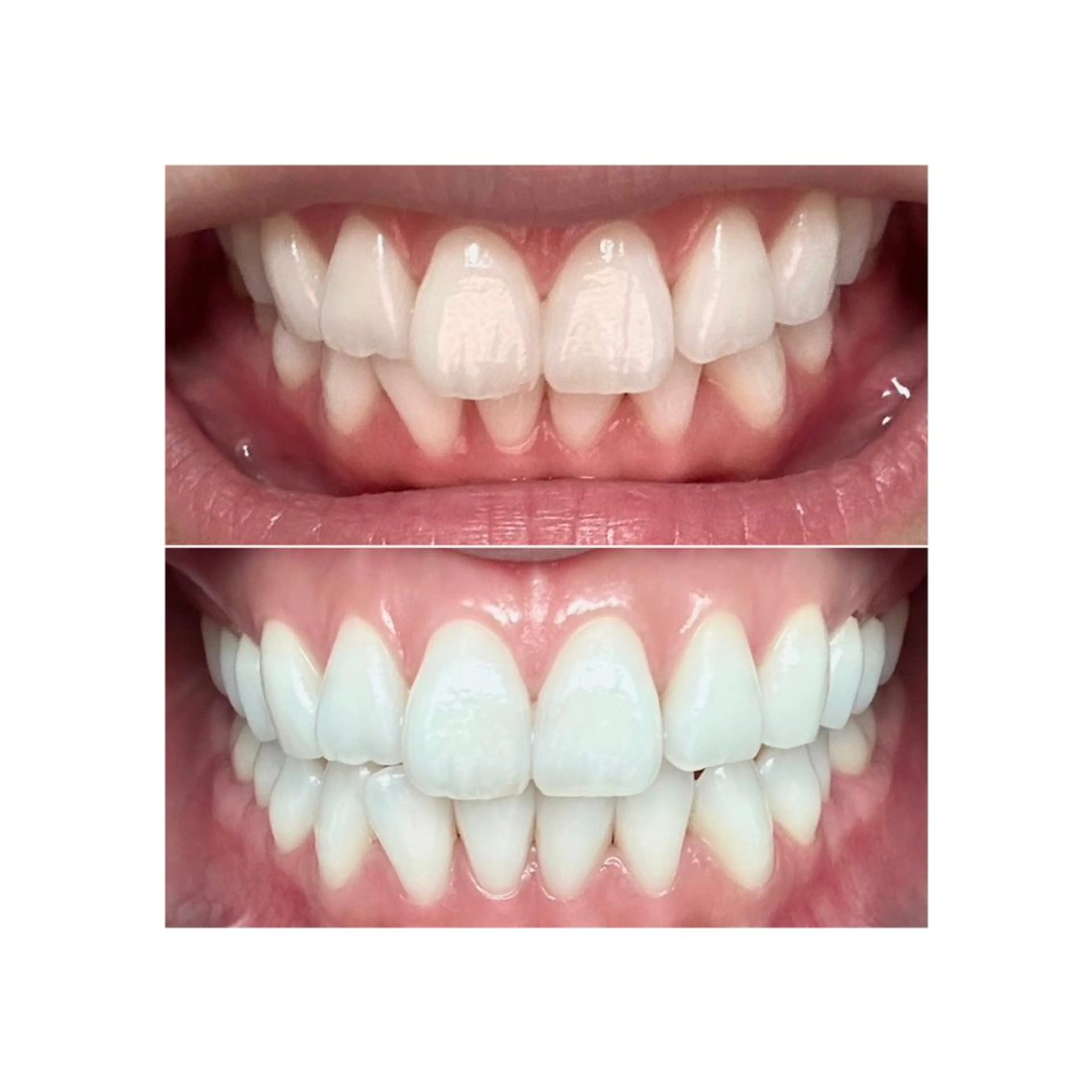 歯を本気で白くしたい方へ【高濃度ジェルホワイトニング】💎30分照射×8回コース→これは本当に歯がどんどん白くなる‼️の写真