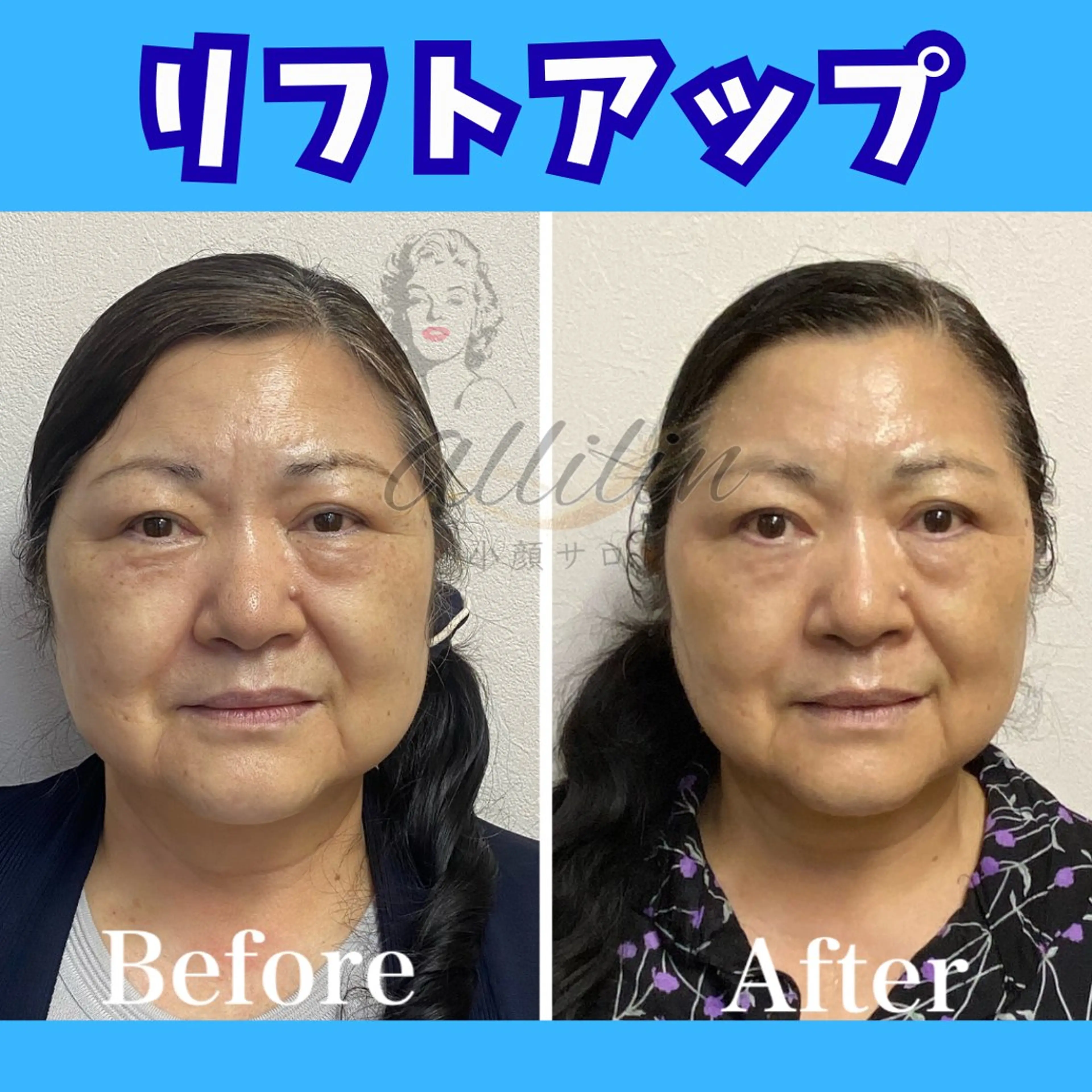 エステ 💎小顔ｻﾛﾝ アリリン銀座💎のエステ・リラクイメージ