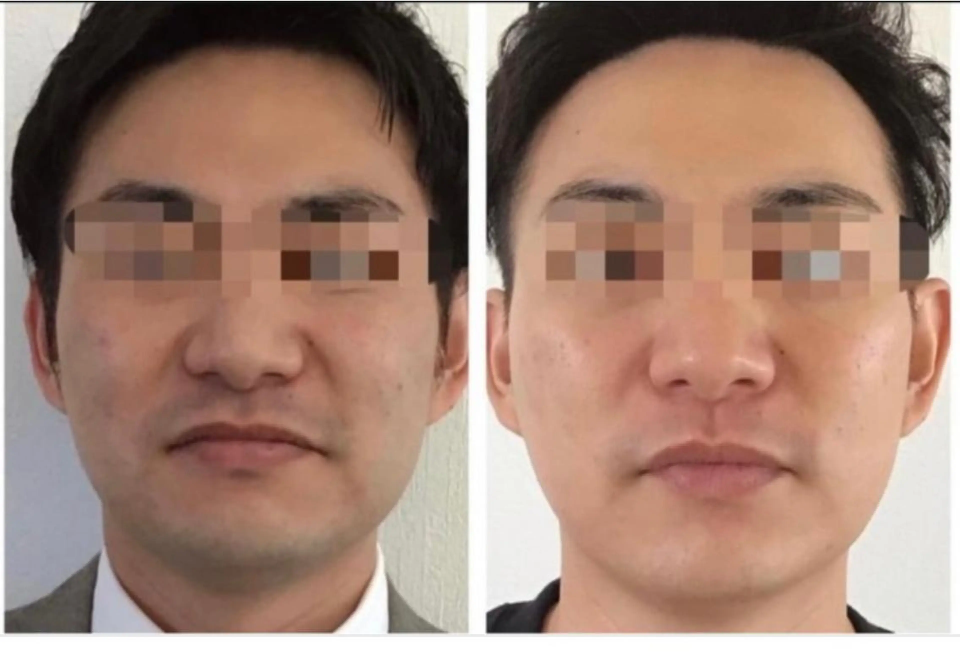 【髭脱毛】毛穴まで綺麗に☺️青髭さようなら🧔🏻‍♂️髭ワックス脱毛！(光➕¥4400)当ててすぐ効果を実感出来る‼️の写真