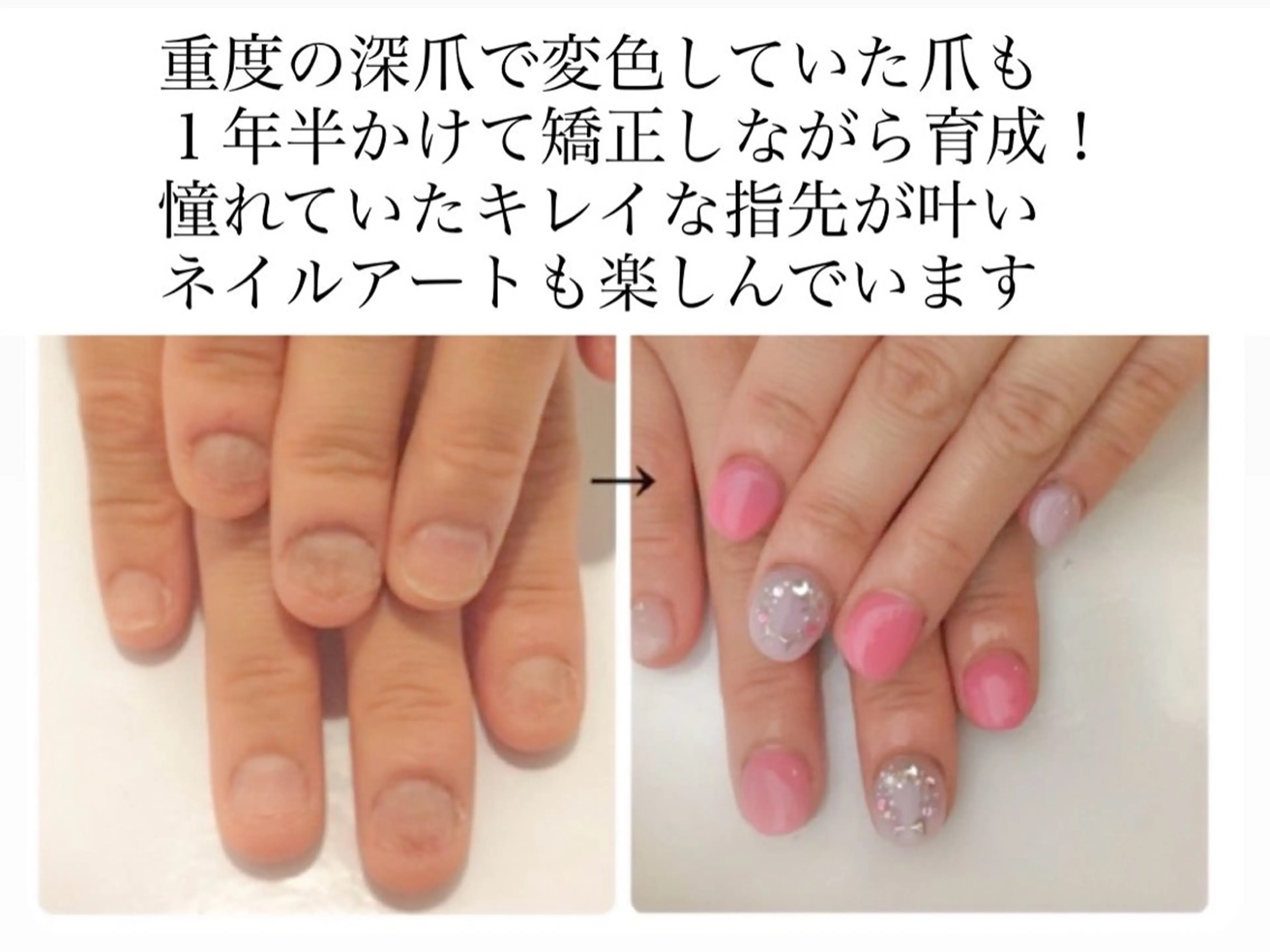 メンズ ネイル フットネイル 深爪矯正専門店　ネイルサロン　トイロ所属・ネイルサロン トイロのネイルデザイン