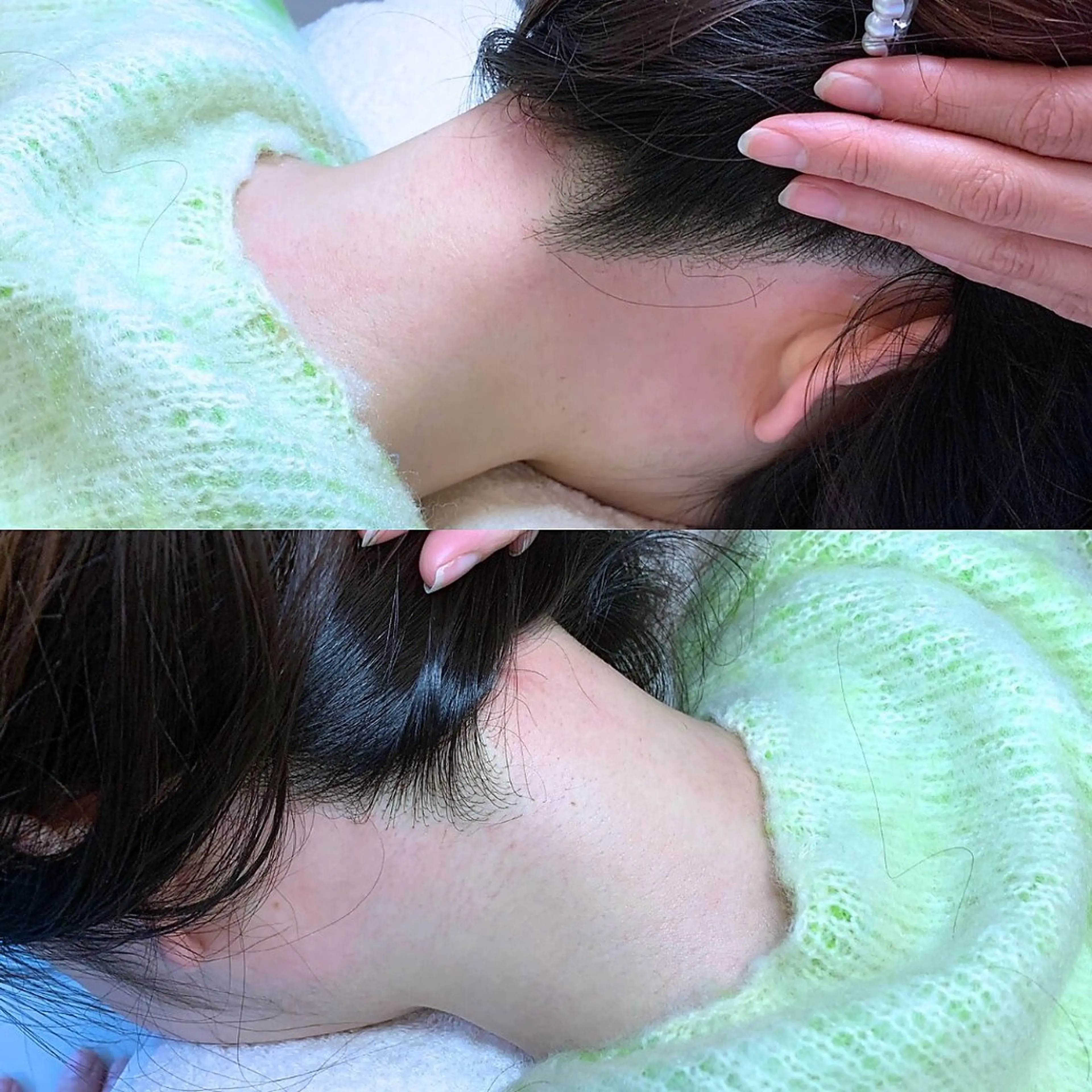 🔸 【うなじw脱毛】wax＋光脱毛✨ 意外とうなじを見られてる？！いつでも髪が結べる自信溢れたツヤ肌うなじへ💖の写真