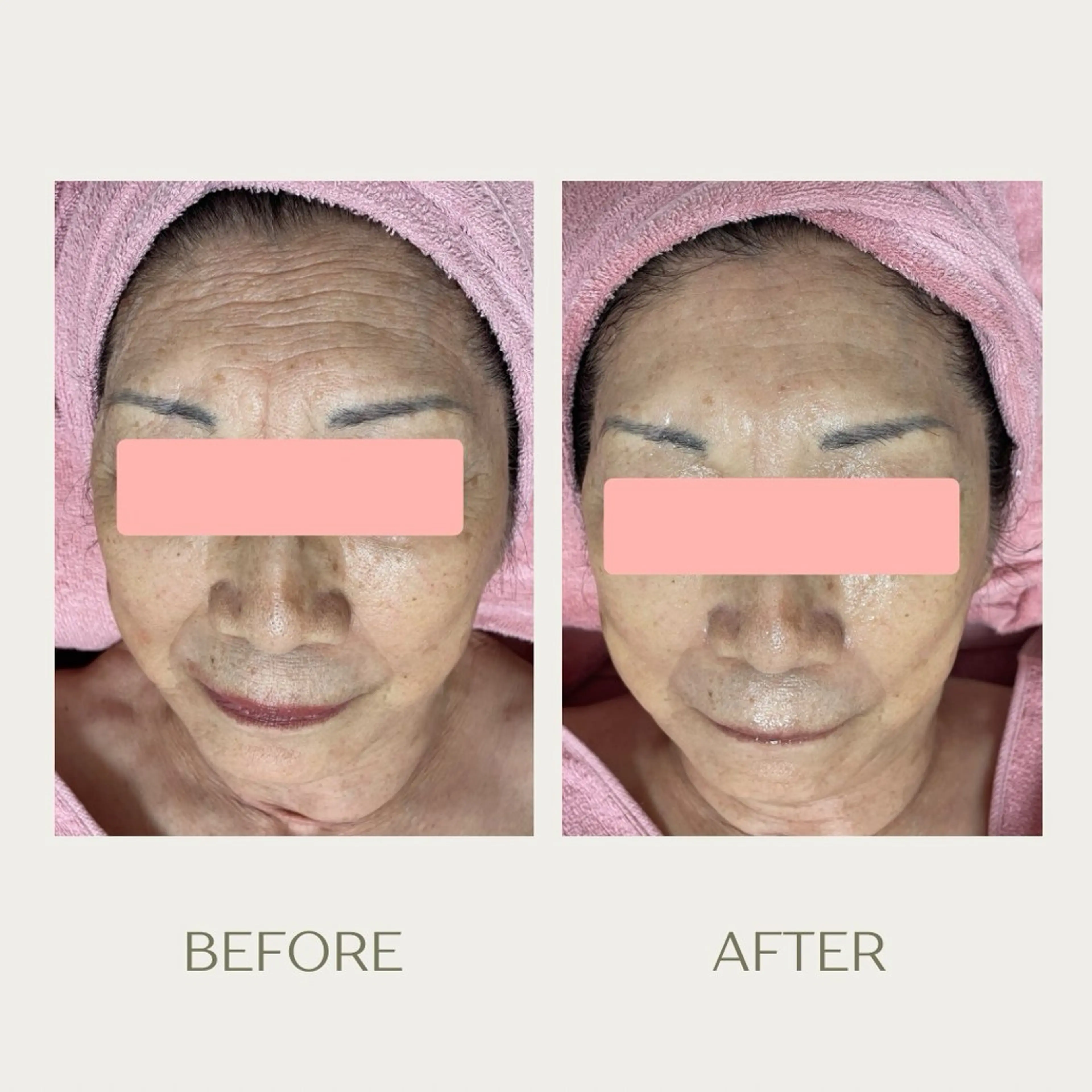 ピーリングケア 🤍moekoのその他イメージ