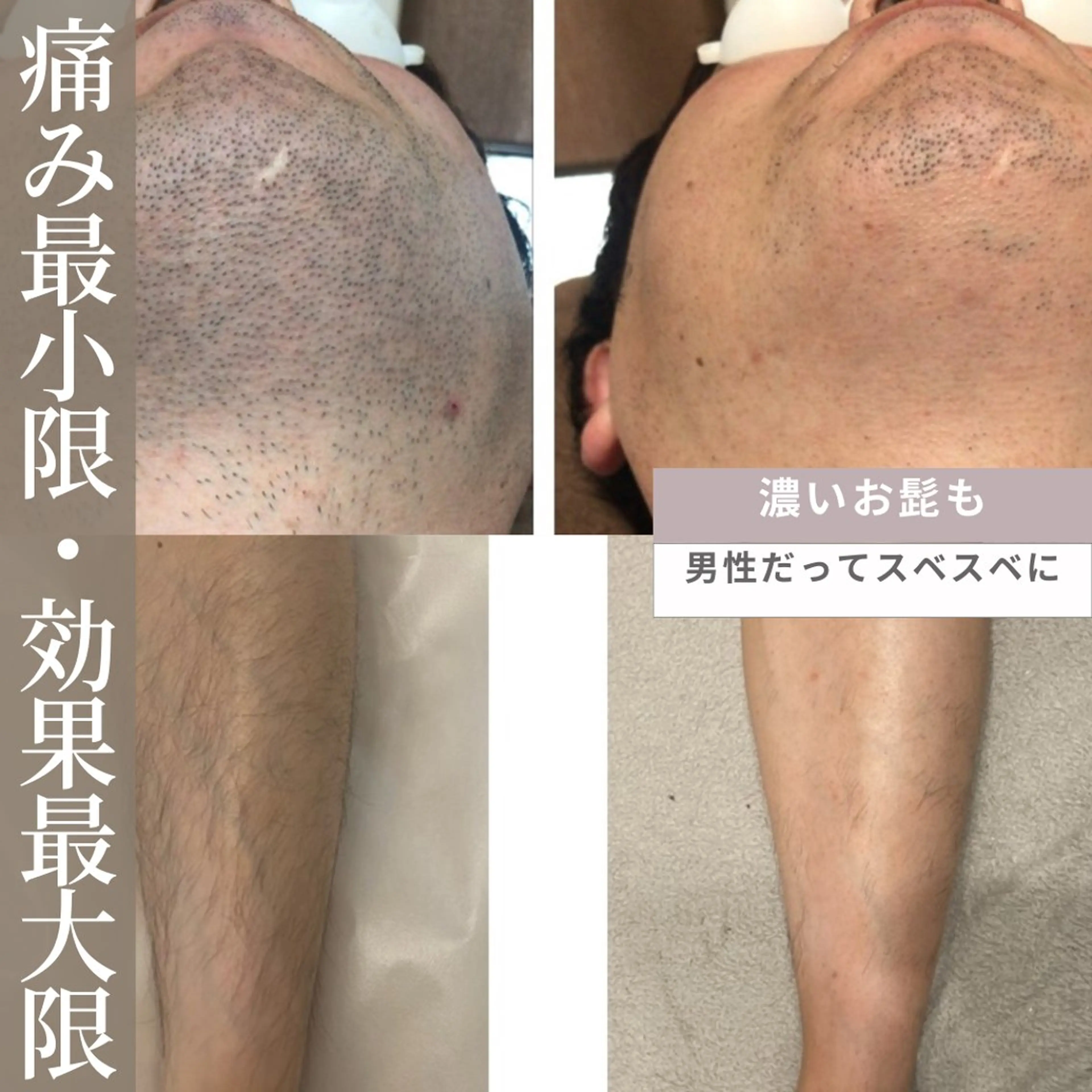 メンズ脱毛🎩👔👞  【顔・前上半身・後ろ上半身・VIO・脚(膝上下)・手(肘上下)】から 2箇所除くメニューの写真