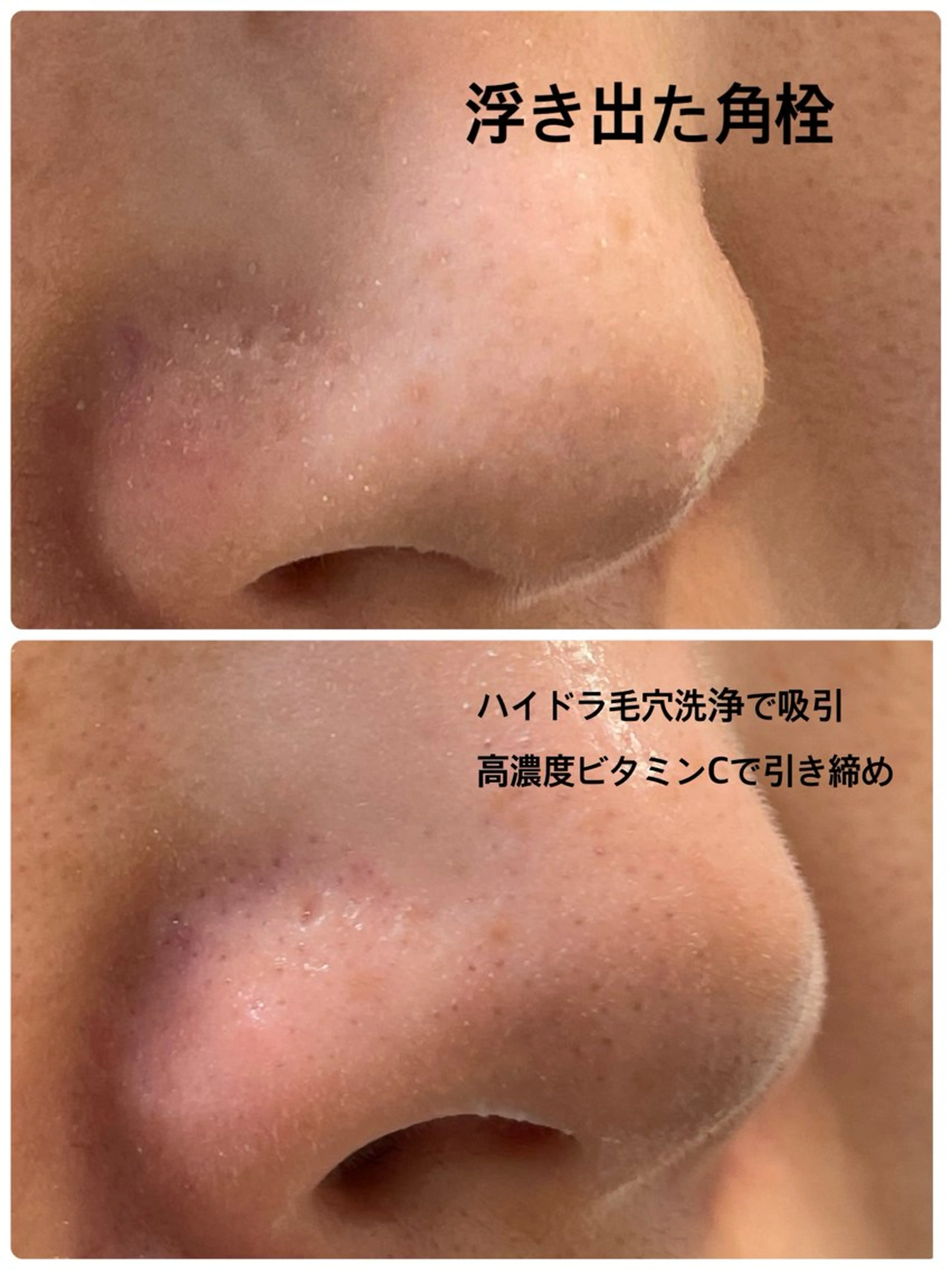 ハイドラ毛穴洗浄/選べるモデリングパック付き¥8,000→¥5,000の写真