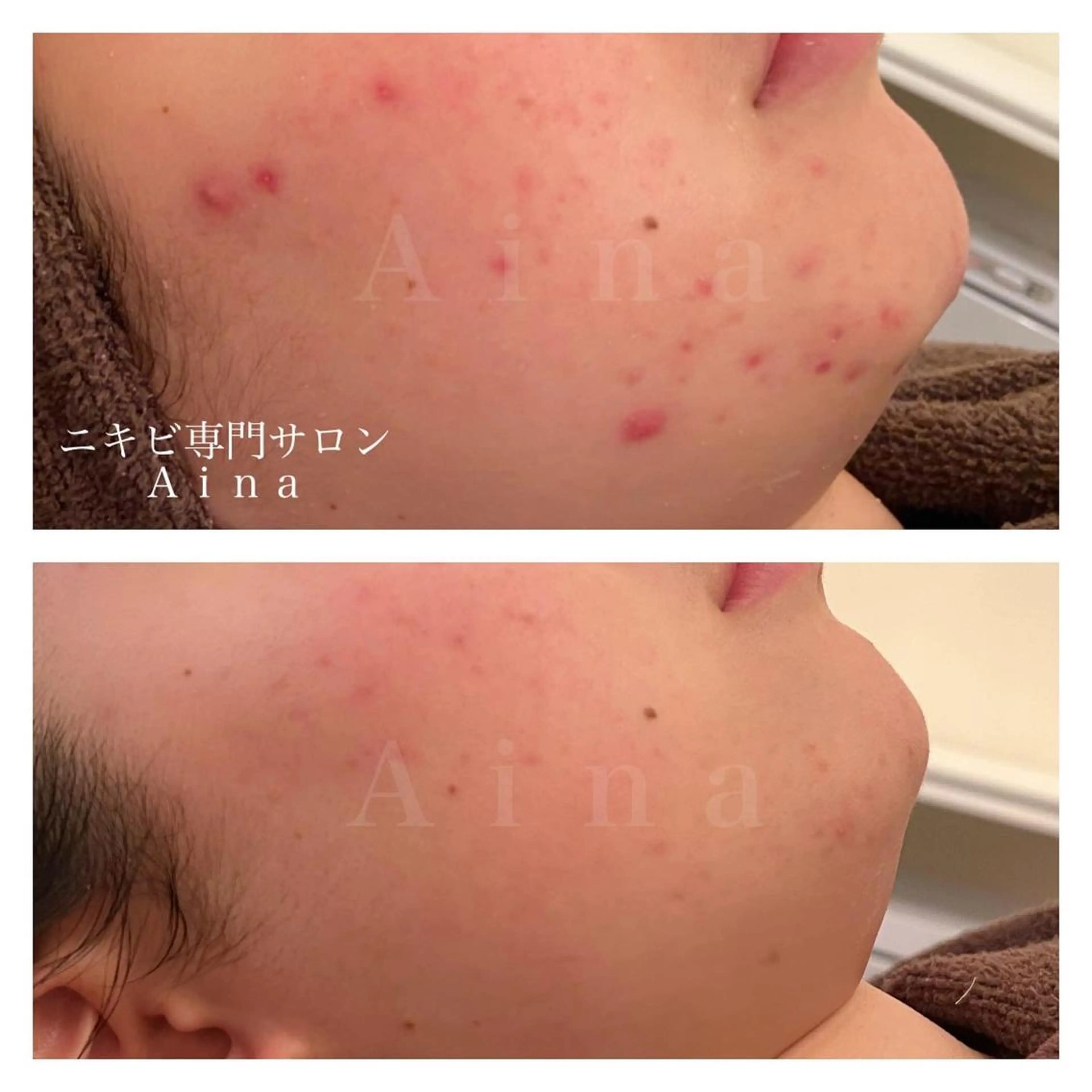 ミディアム カラー パーマ ヘアアレンジ メンズ キッズ ネイル マツエク・マツパ アイブロウ 学生（メンズ向け） 学生 ニキビ跡専門サロン Ａｉｎａのエステ・リラクイメージ