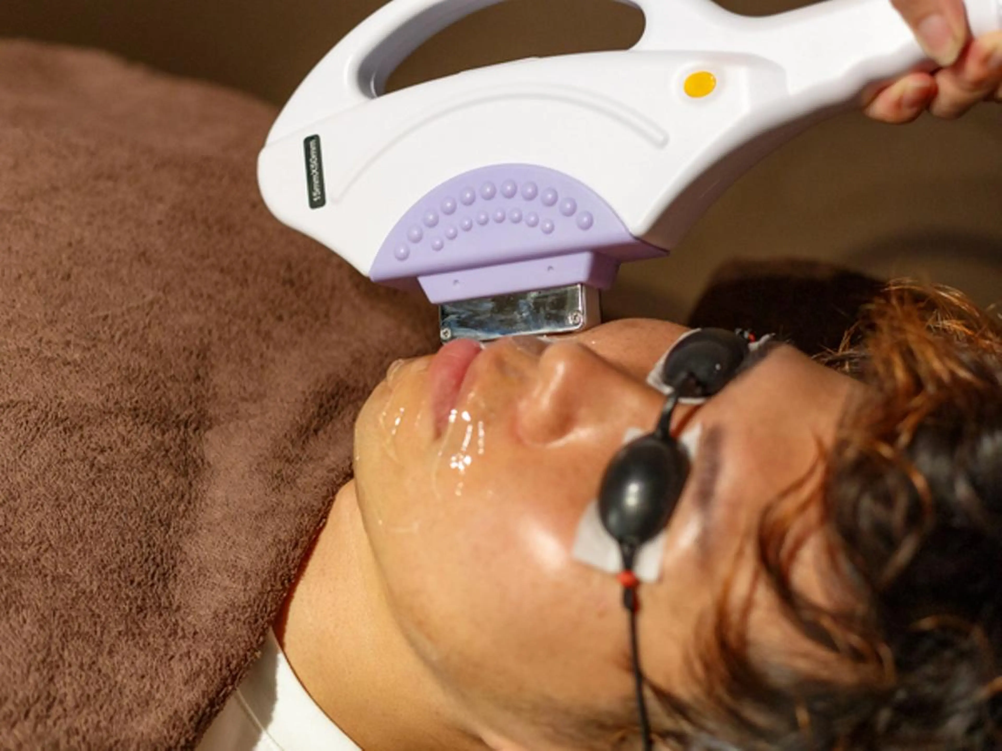 ヒゲ脱毛3箇所の写真