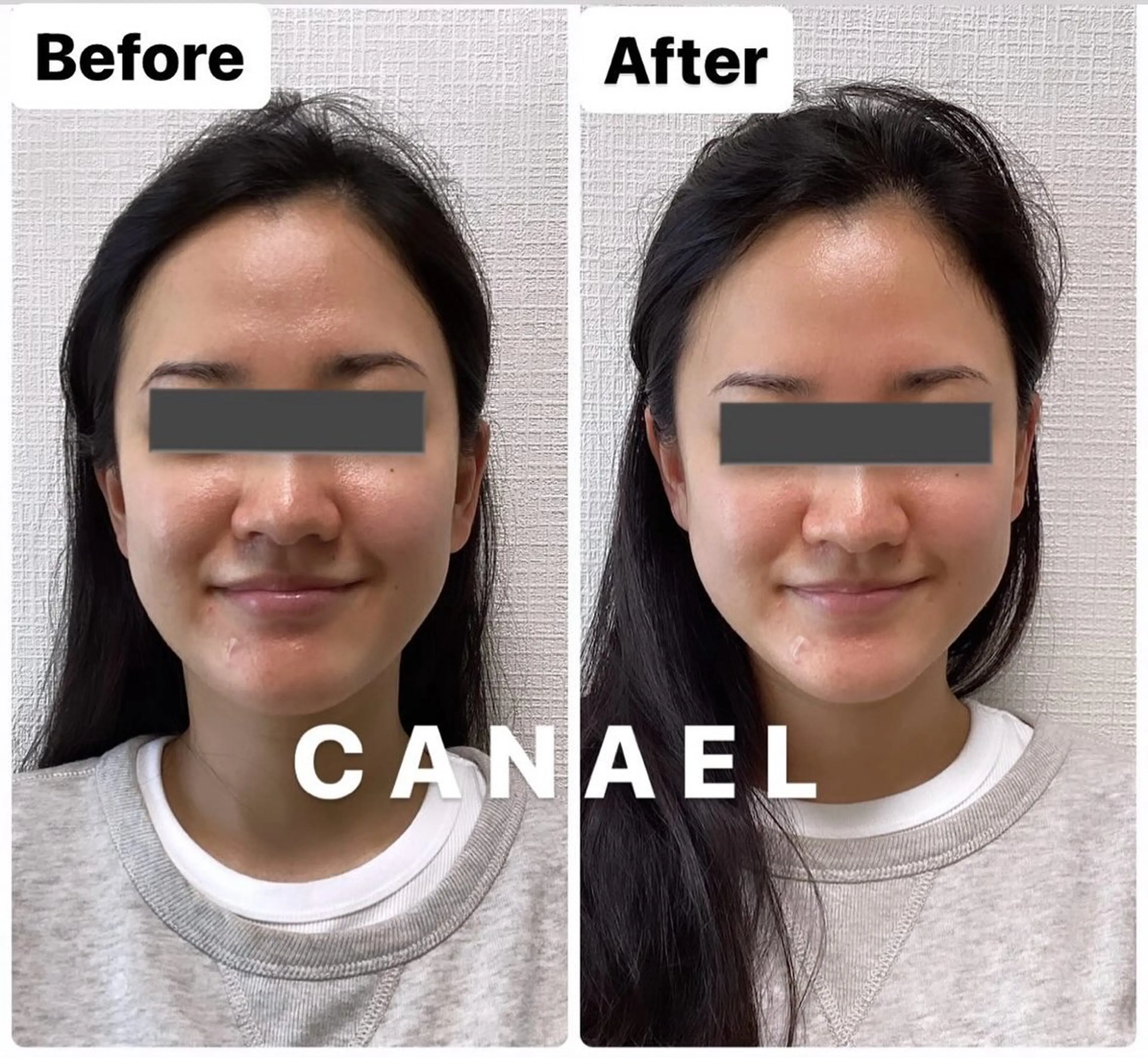 モニター★人気No.1★【整形級の小顔矯正】＋【脳洗浄/頭皮はがし】で更に小顔効果◎小顔をより実感したい方は絶対こちら！の写真