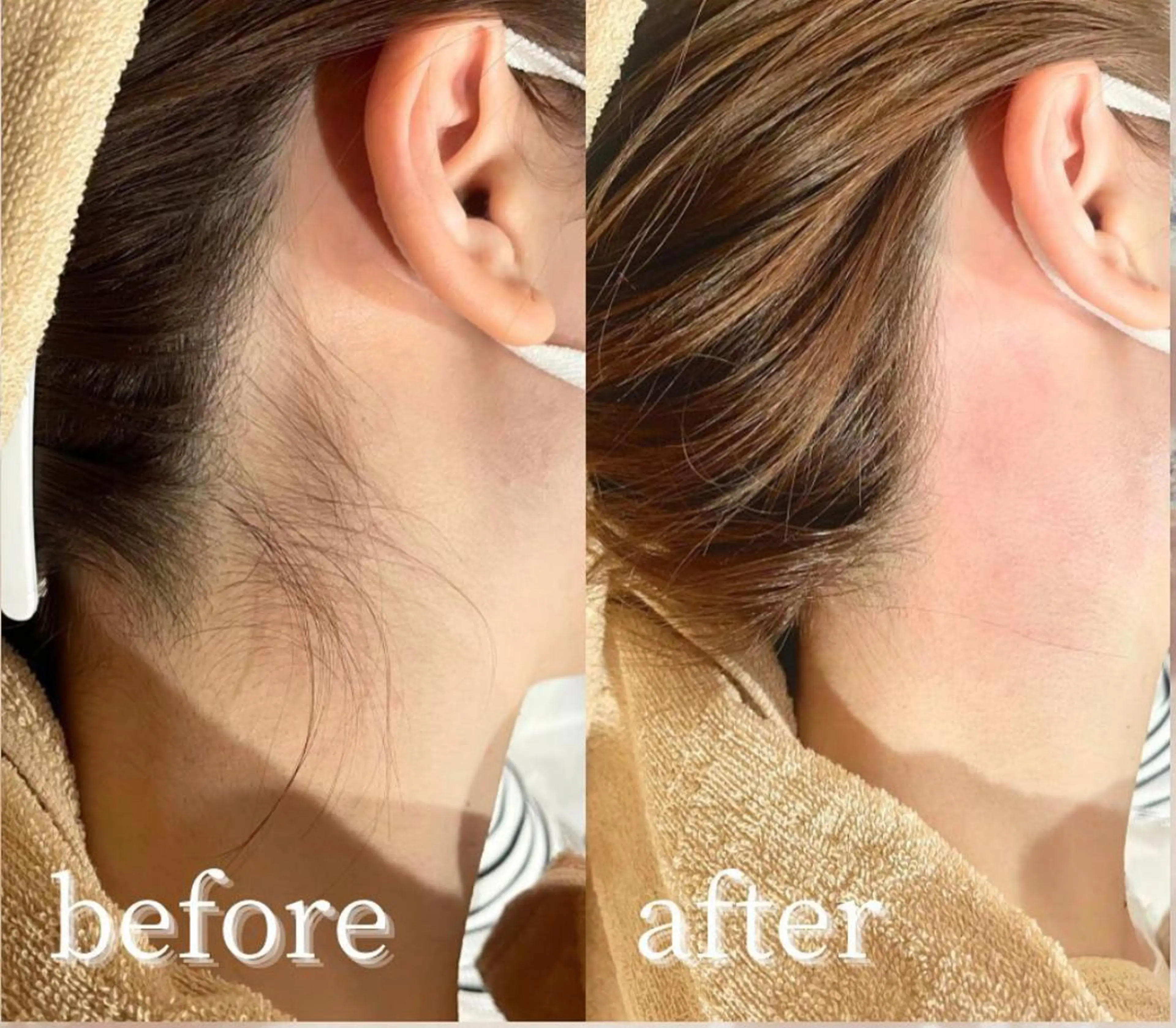 🇯🇵✨ 新規様限定メニュー：うなじ美人ワックス脱毛ケア ✨🇧🇷 アップスタイルが際立つ！憧れの「うなじ美人」へ！の写真