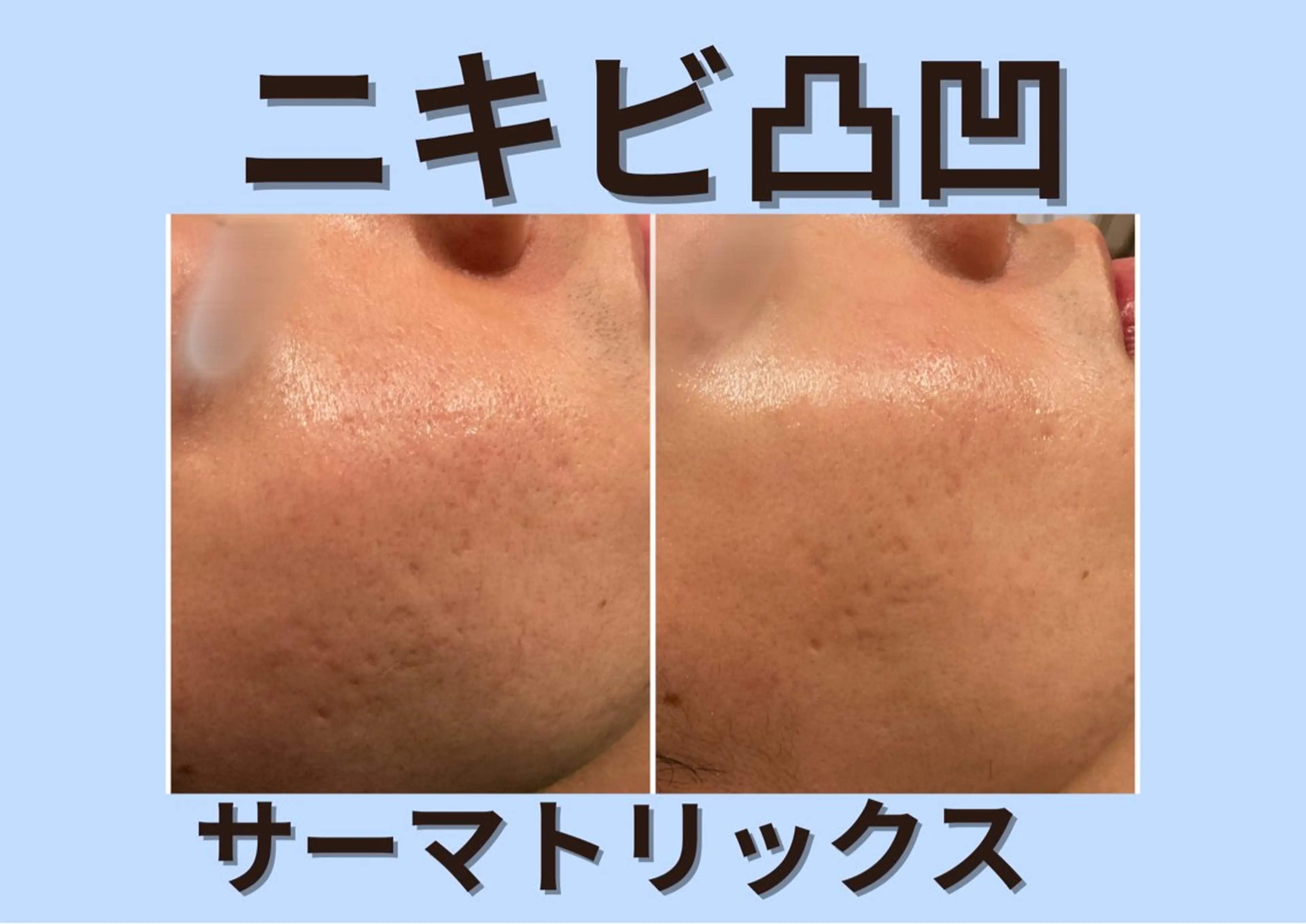 【春のイベント前にニキビ跡・クレーター改善】サーマトリックス｜頬のみサーマトリックス照射＋鎮静パック付き！の写真