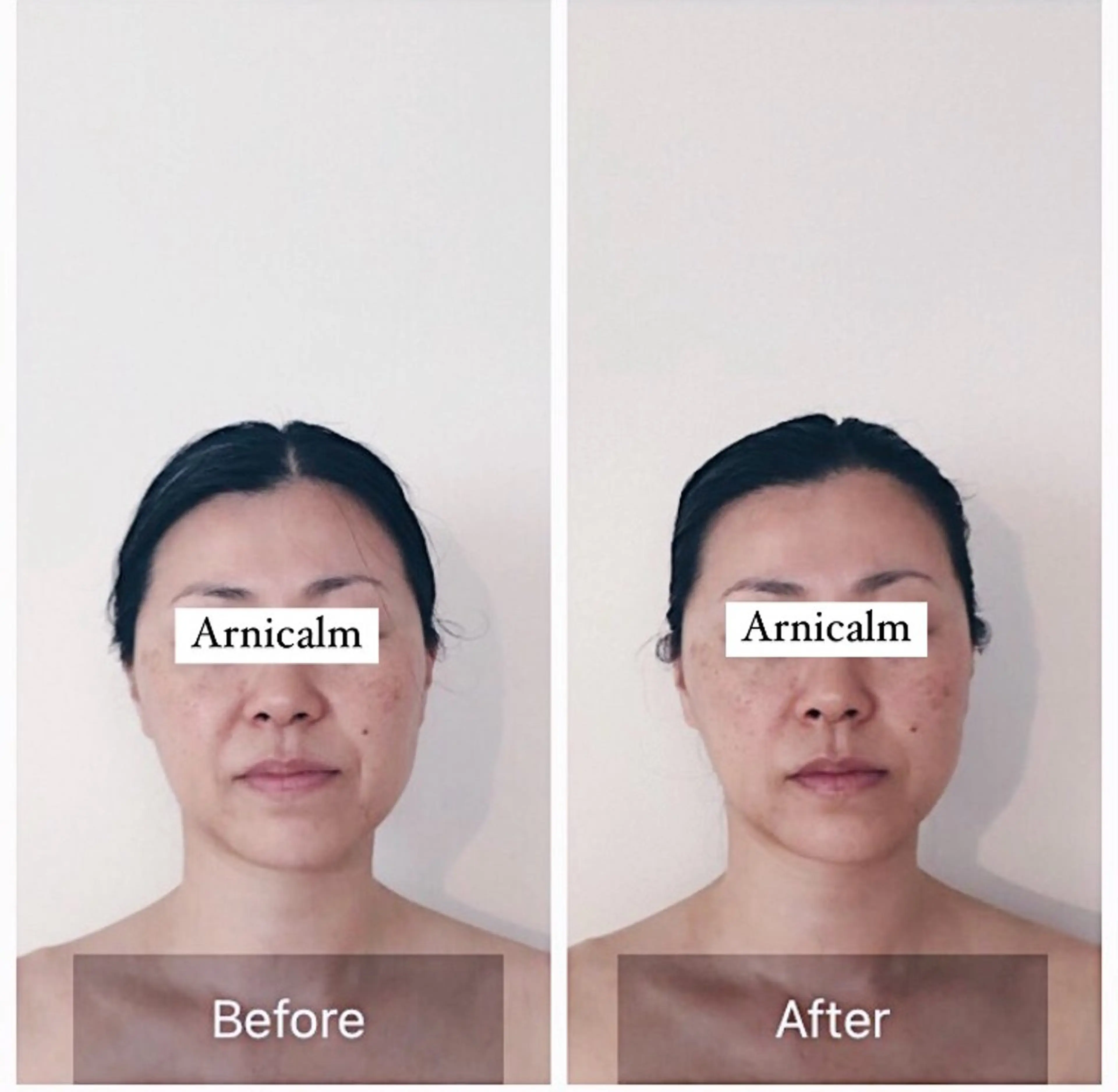 ハーブピーリング 肌再生ピーリング/のエステ・リラクイメージ