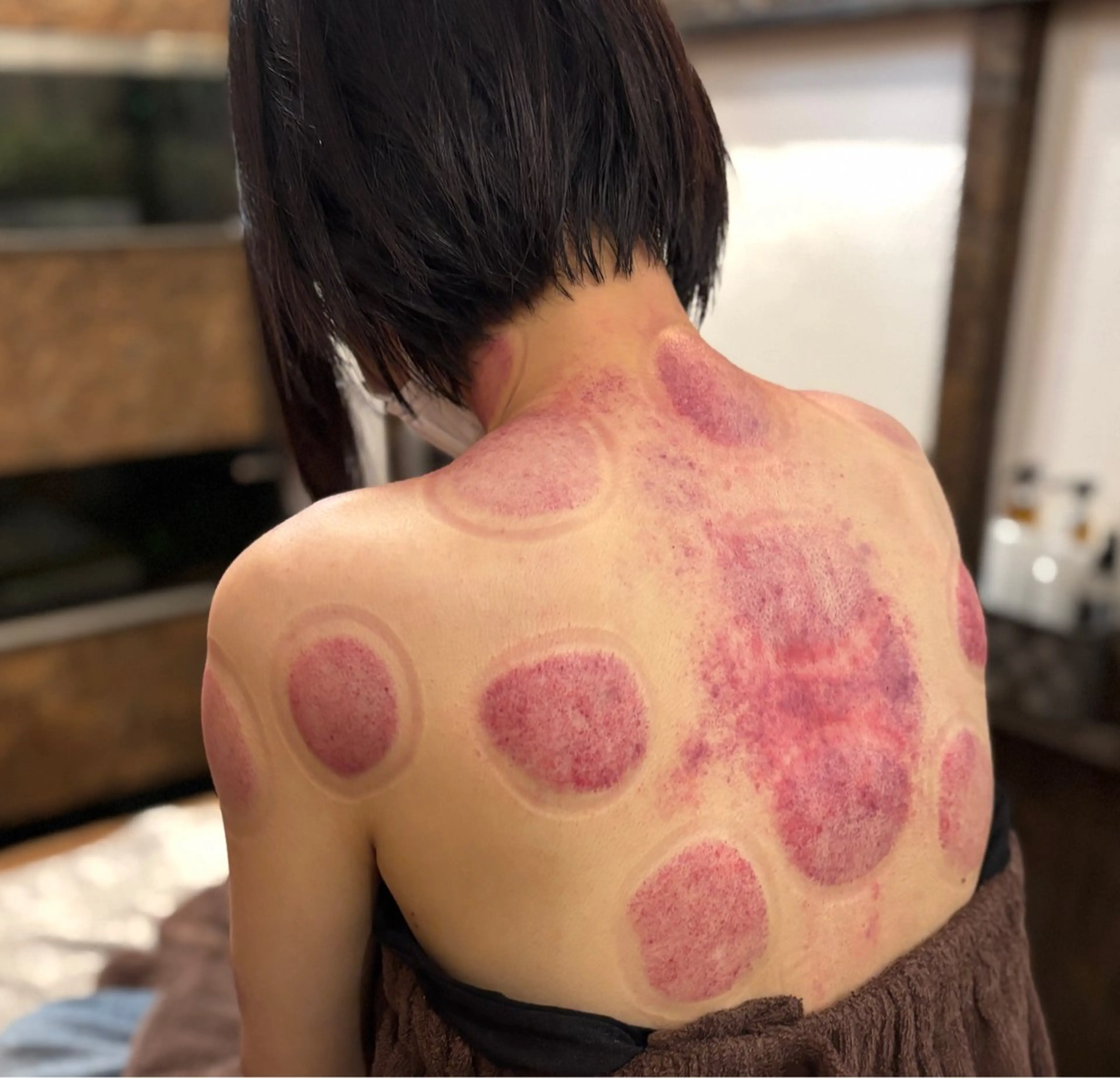 【体験、お試し】首・肩こりスッキリ「かっさ+吸い玉」コースの写真