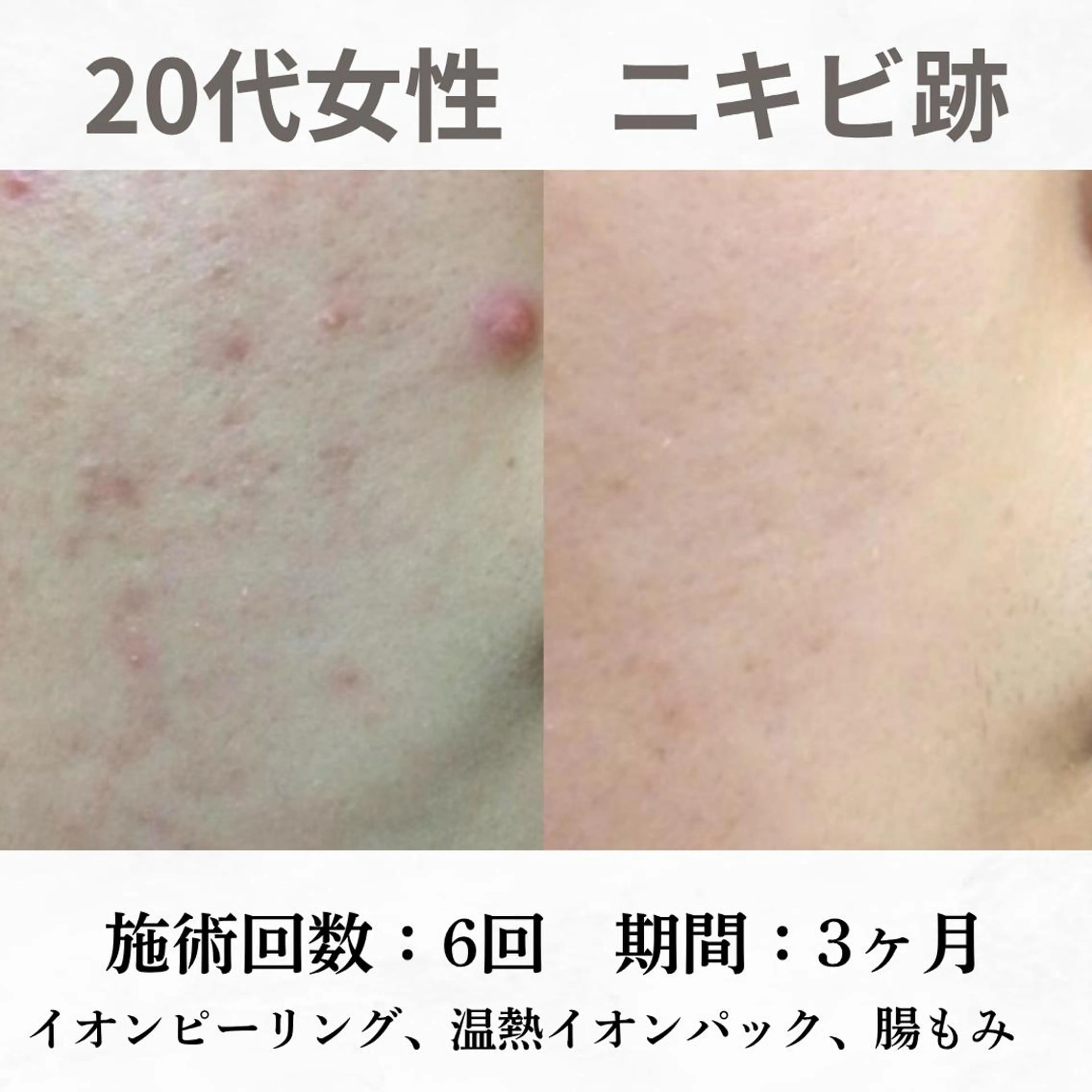 重度ニキビ専門🌷 ダウンタイムなしのエステ・リラクイメージ