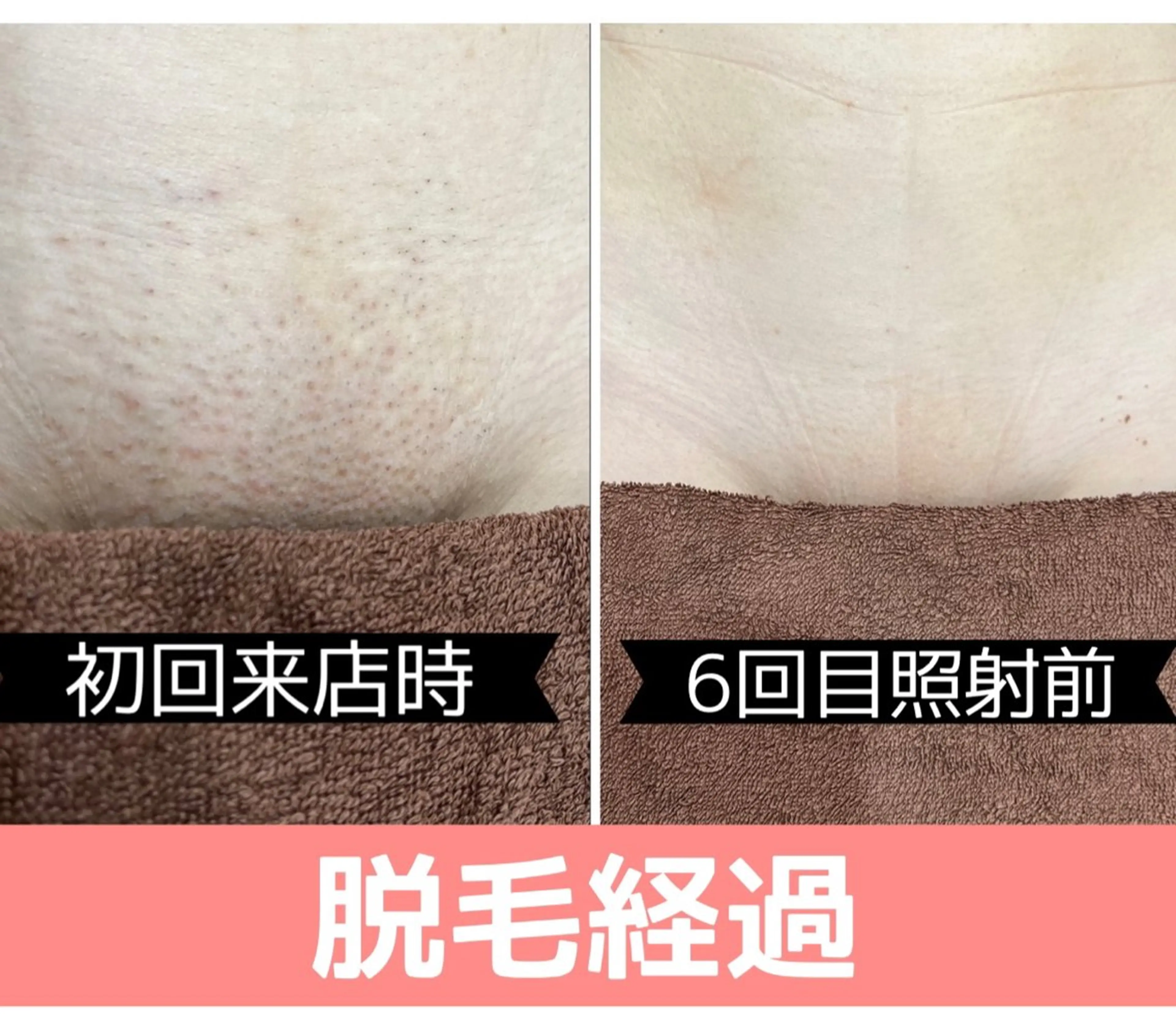 脱毛 毛穴改善/脱毛 ネイル　川上久仁子のエステ・リラクイメージ