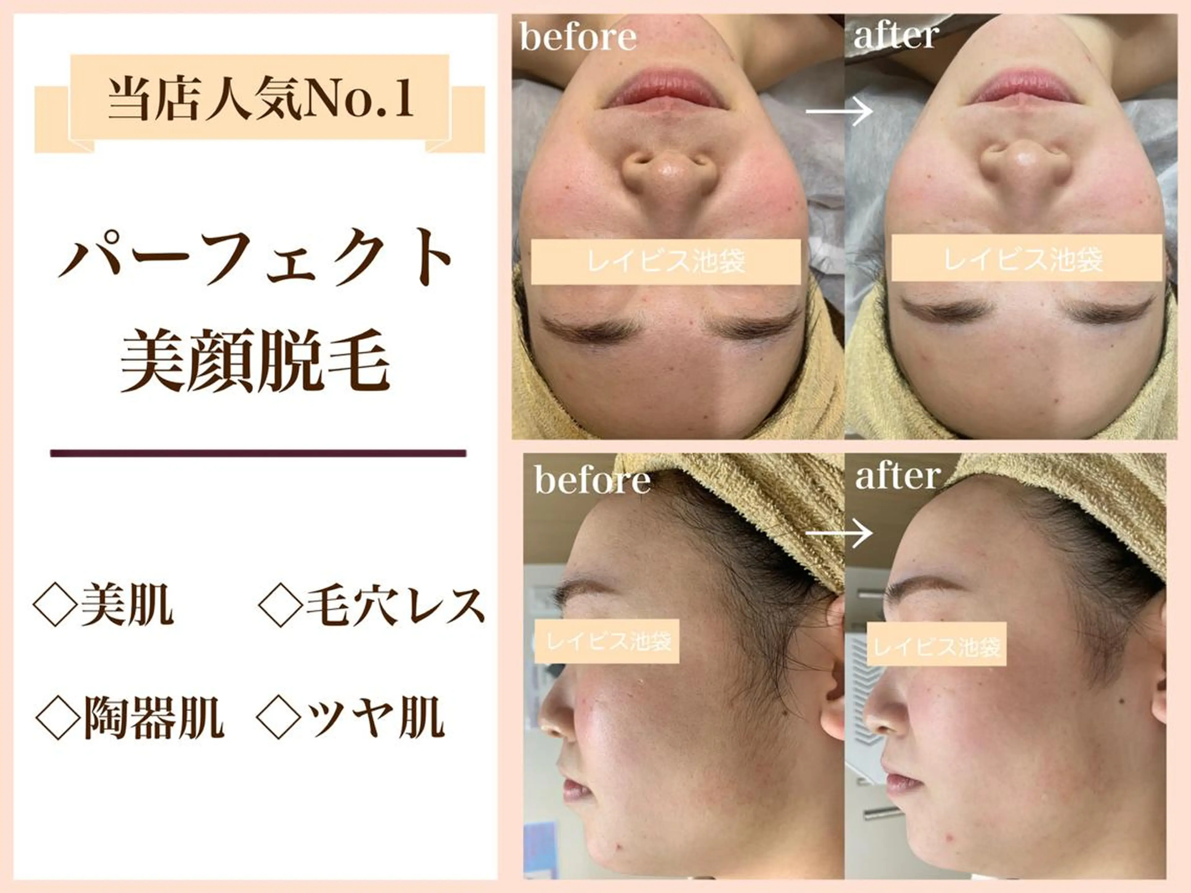 1番人気【🤍韓流美肌脱毛🤍】脱毛とフェイシャルのいいとこどり💕ピーリング+パックでつる艶🐻❄️毛穴/美白/小顔の写真