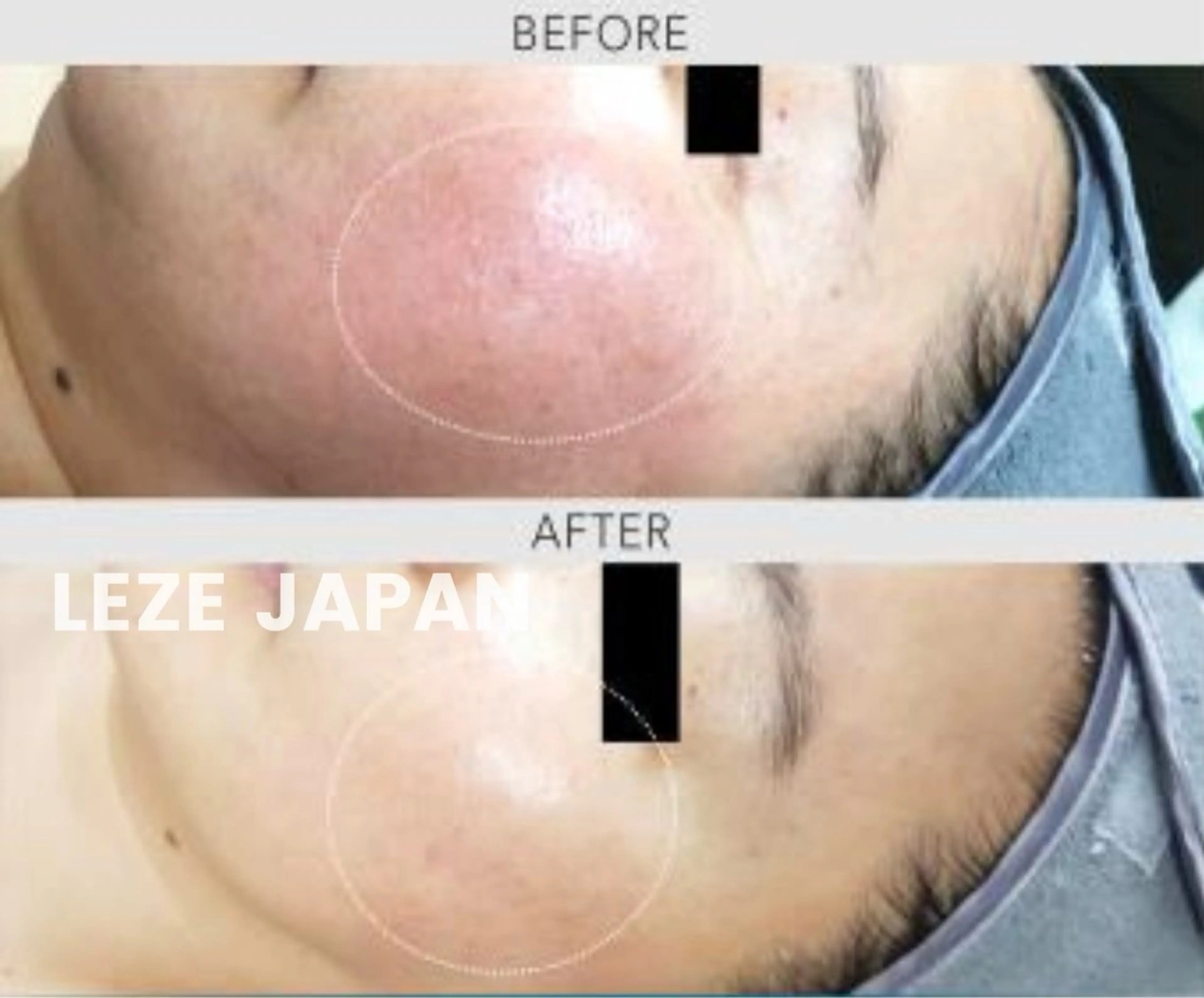 韓国肌管理🇰🇷ババスバブルセラピーの写真