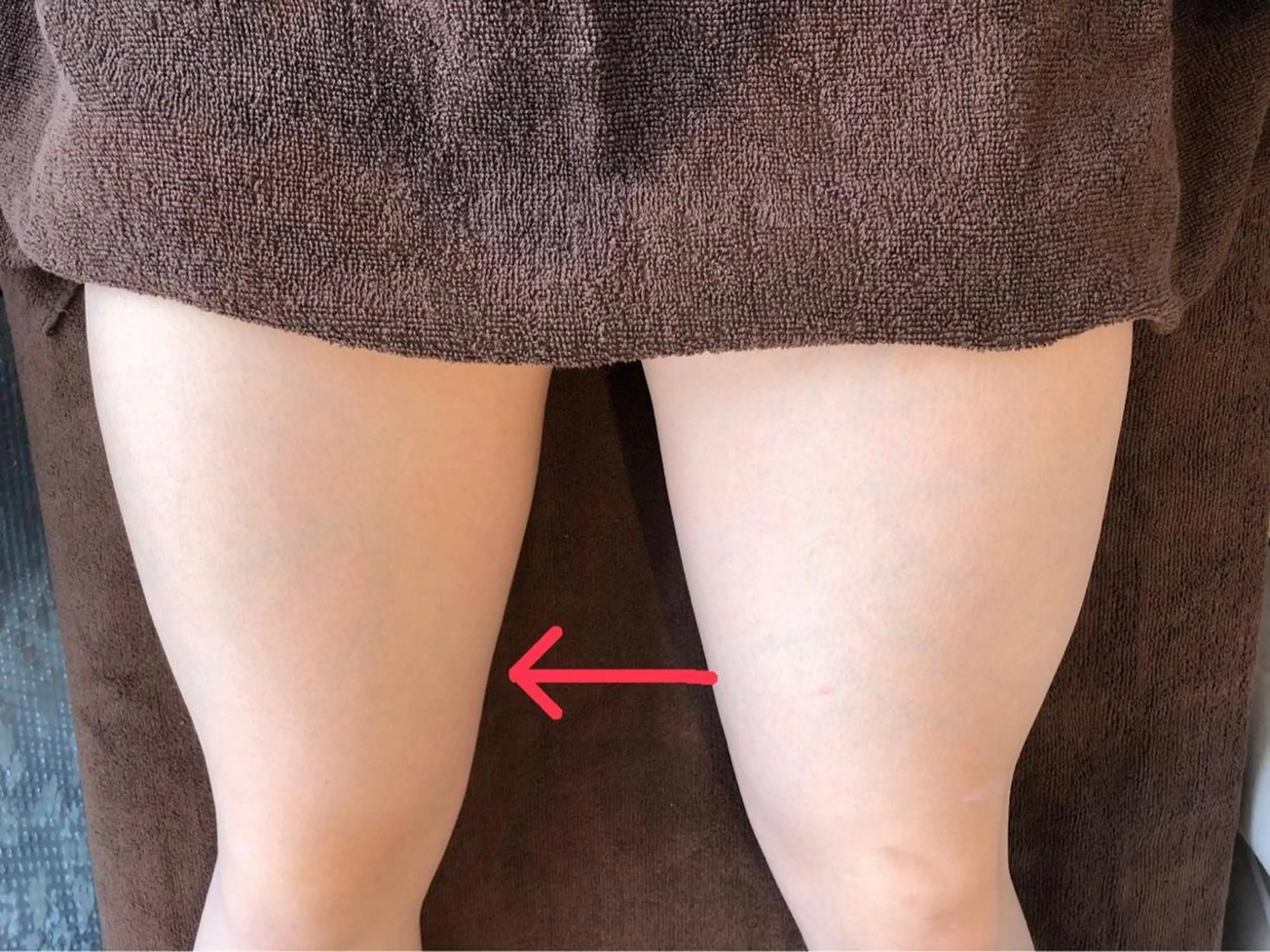 【太もも痩身】なかなか落ちない太ももをスッキリシャープに！一度で効果的面！国内最高級マシン使用で安心安全に部分ダイエットの写真