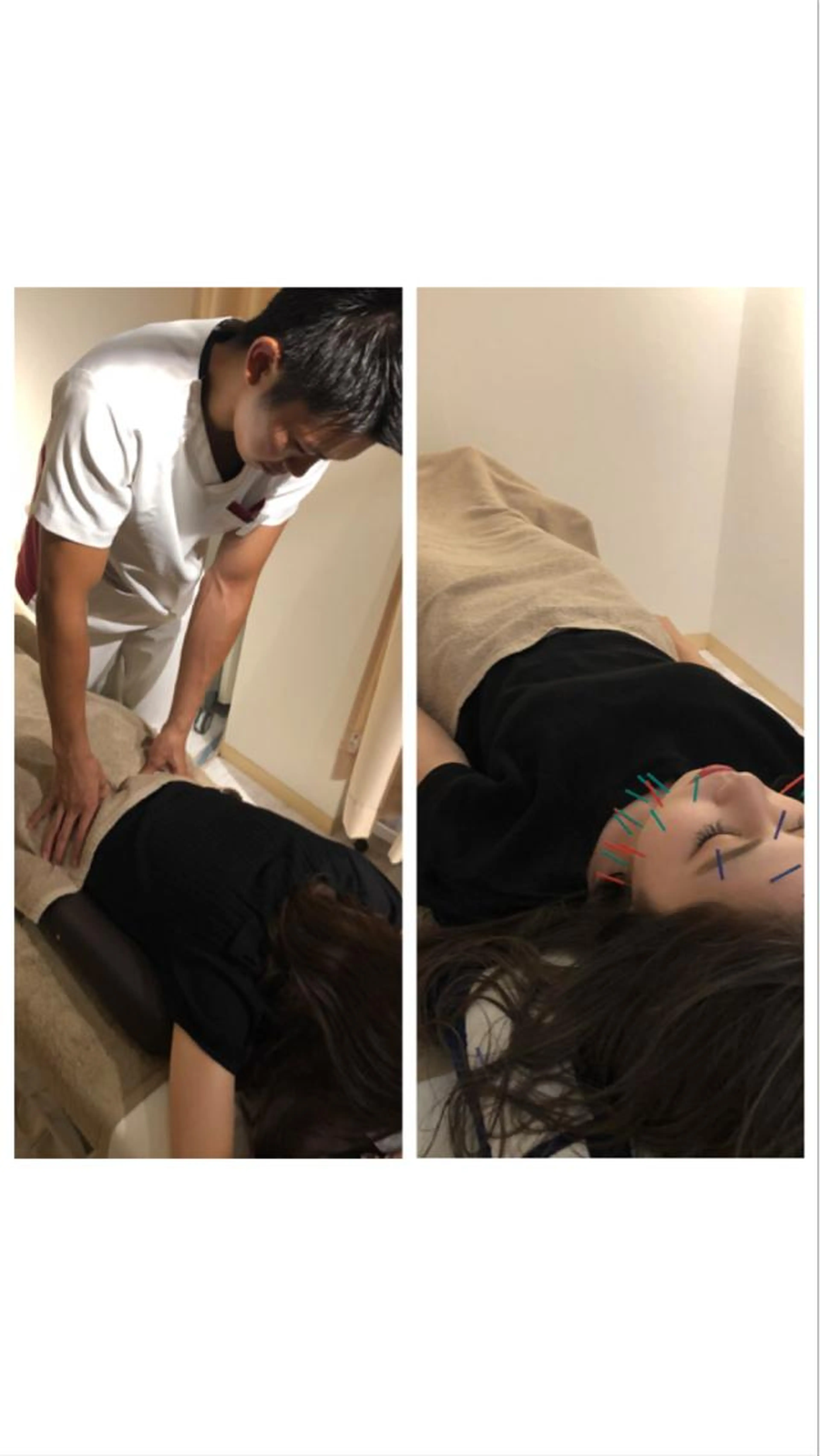 人気メニュー美容鍼＋美容整体セット顔だけではなく一緒に身体のメンテナンスを行う事でフェイスラインもスッキリします。の写真