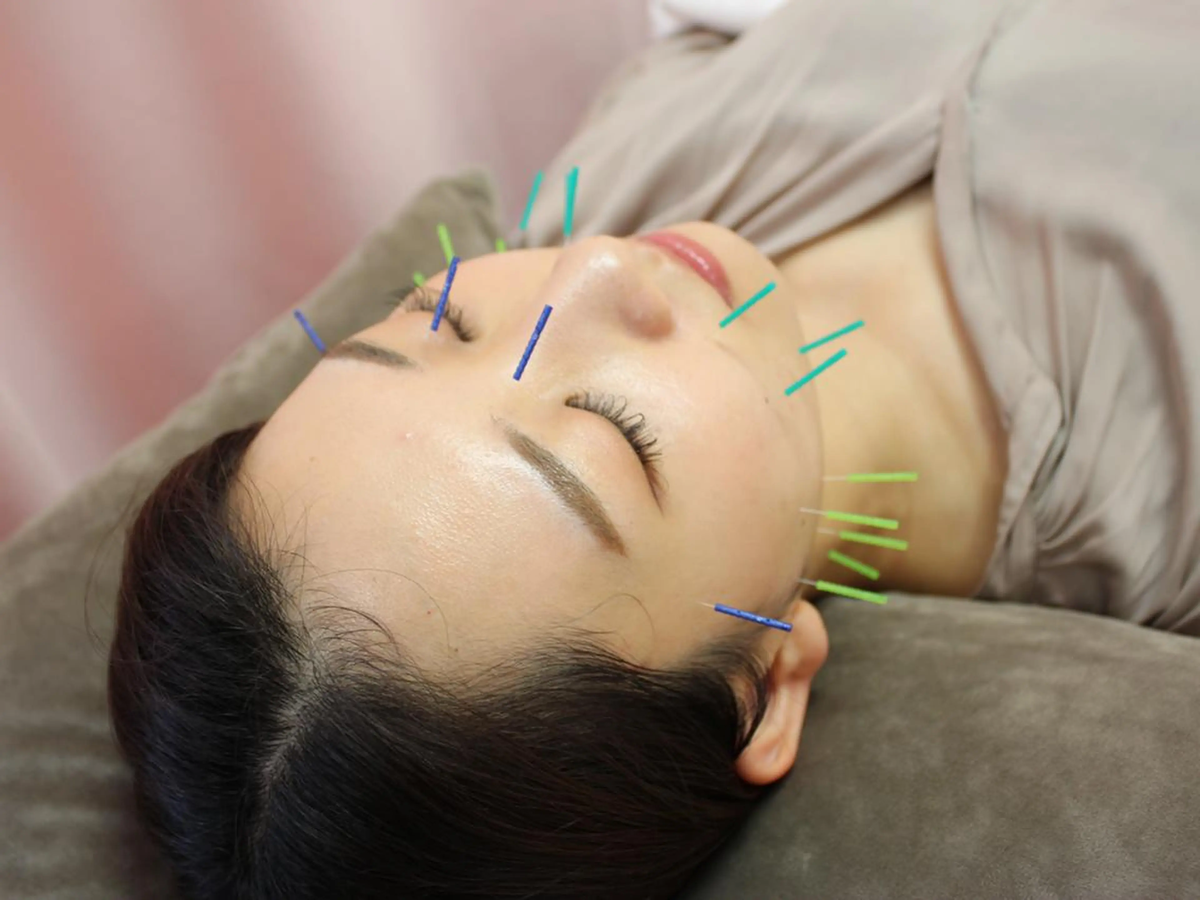 【新規限定】美容鍼+小顔整体 カウンセリング付 70分 ¥4,300の写真