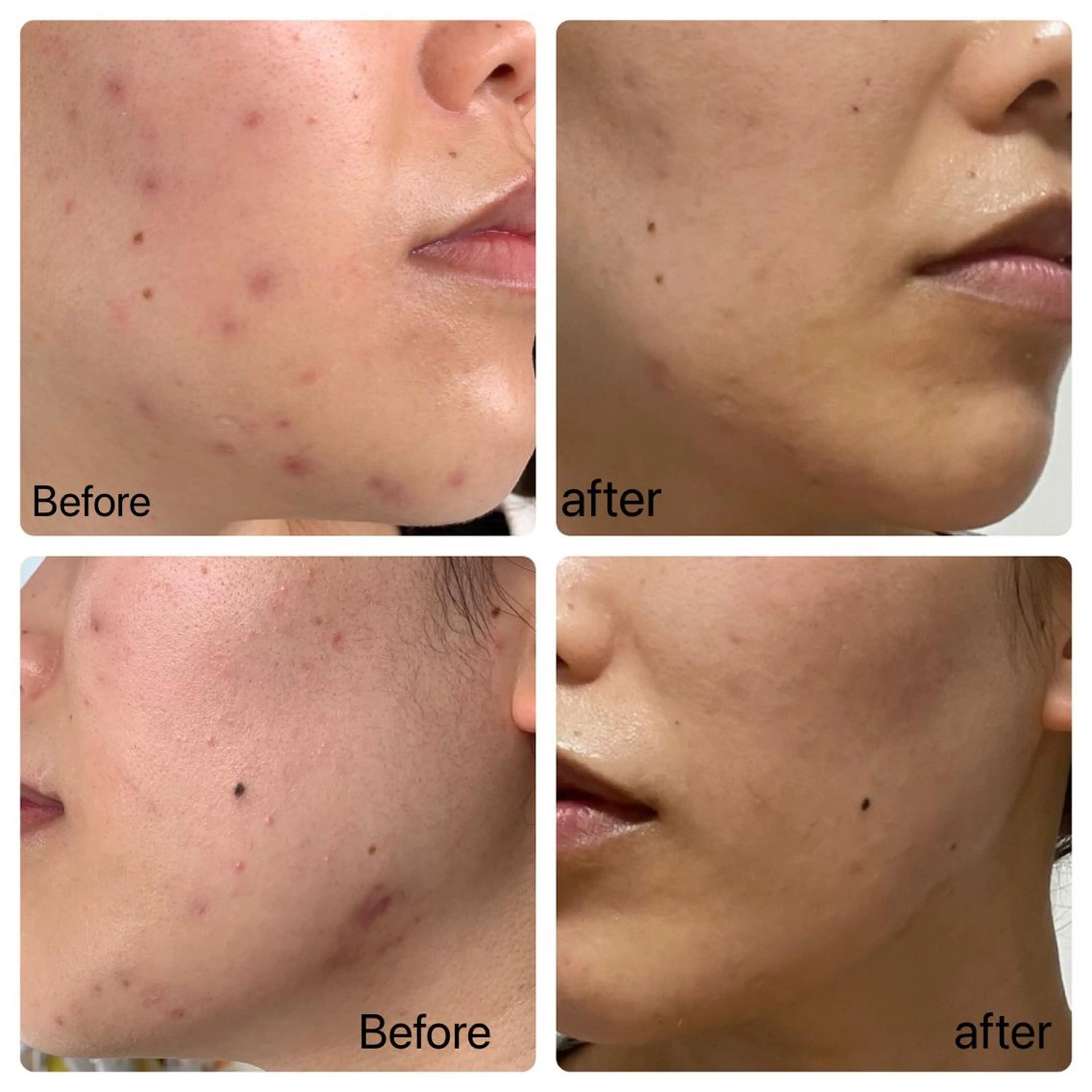 脱ニキビモニター☀️2ヶ月分のエステとスキンケア💆♀️の写真