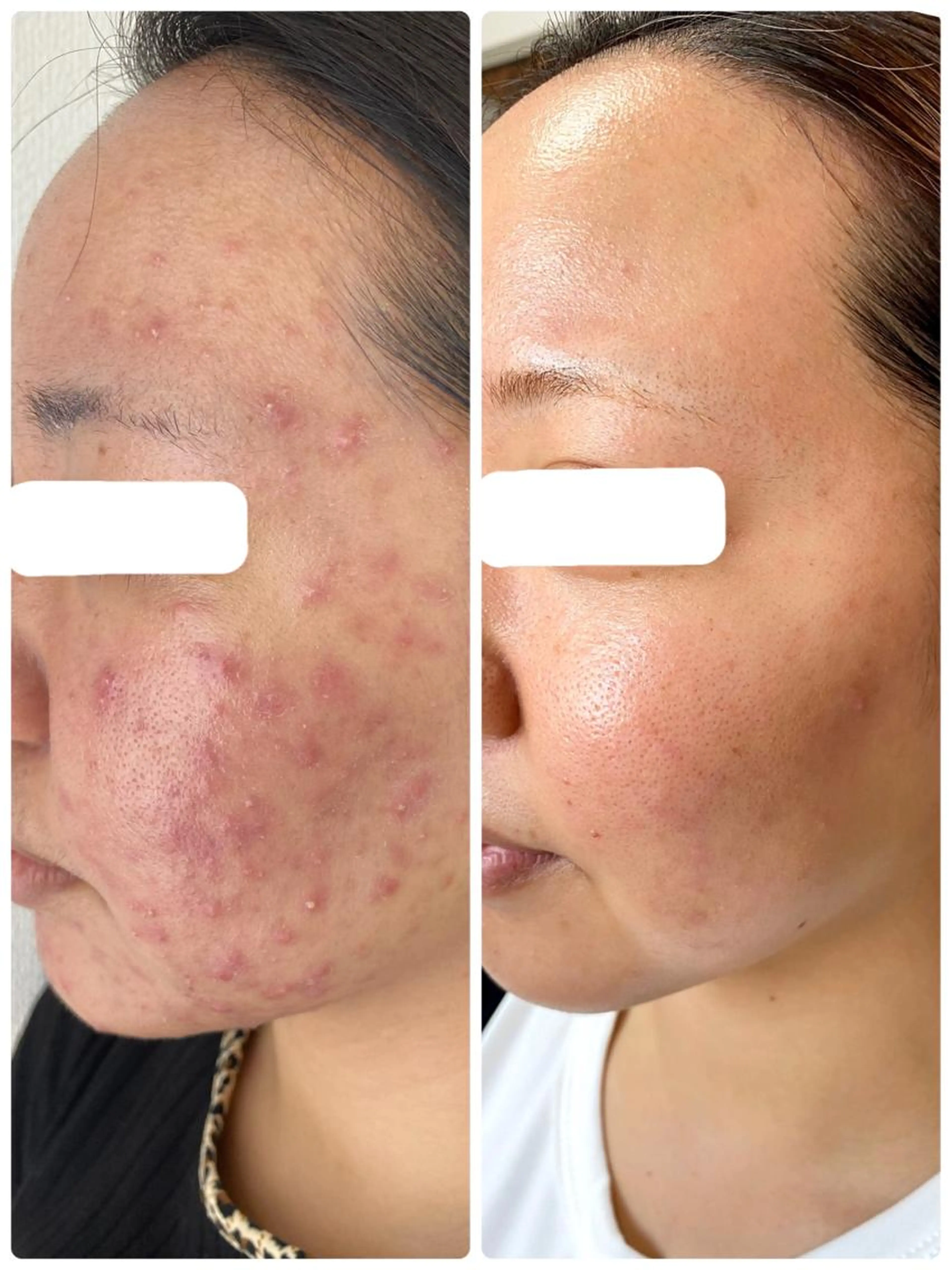 小顔&美肌のW効果💗【超音波エステ】の写真