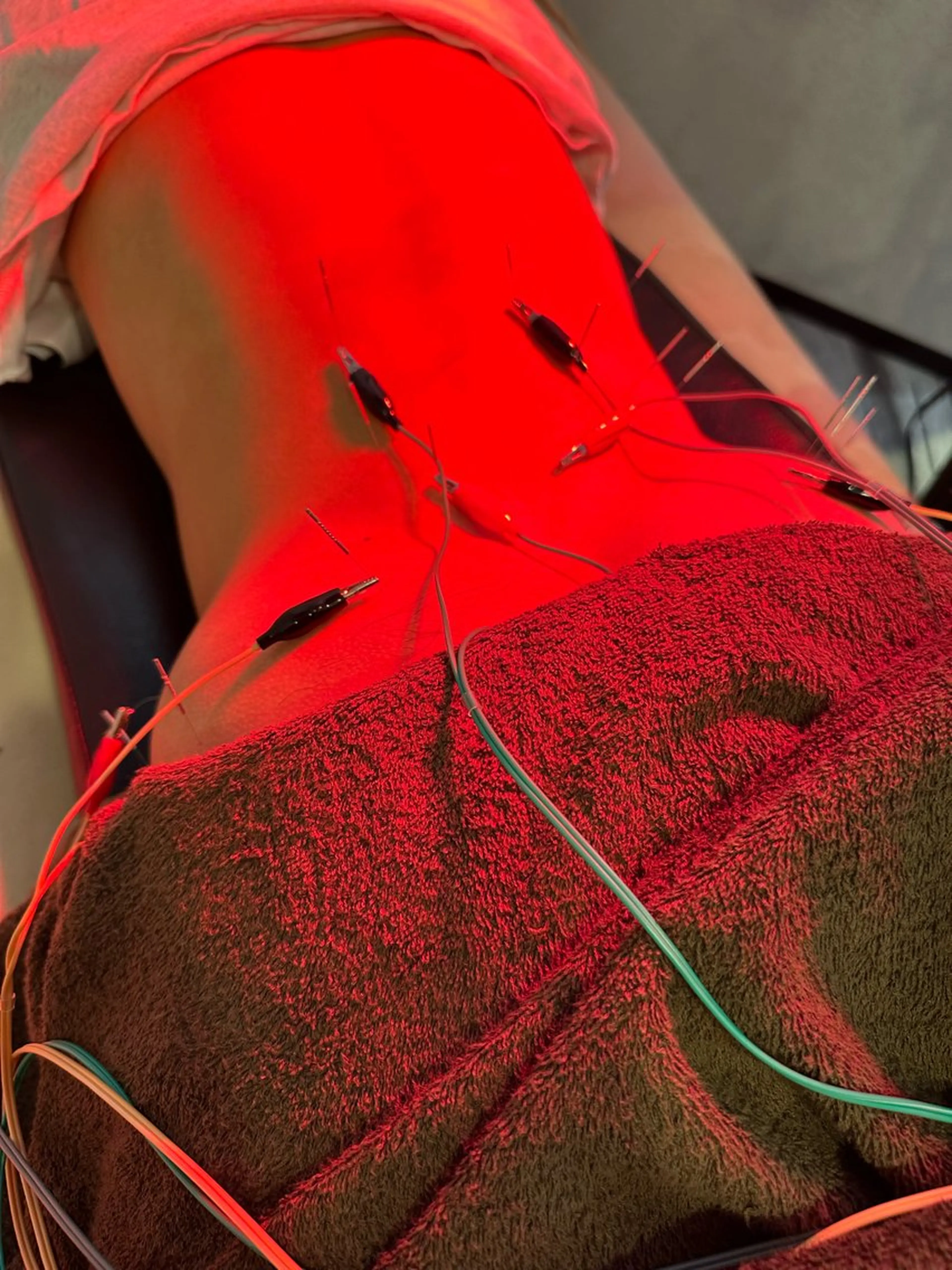 その他 小顔矯/美容鍼/鍼灸 BeauJuのその他イメージ