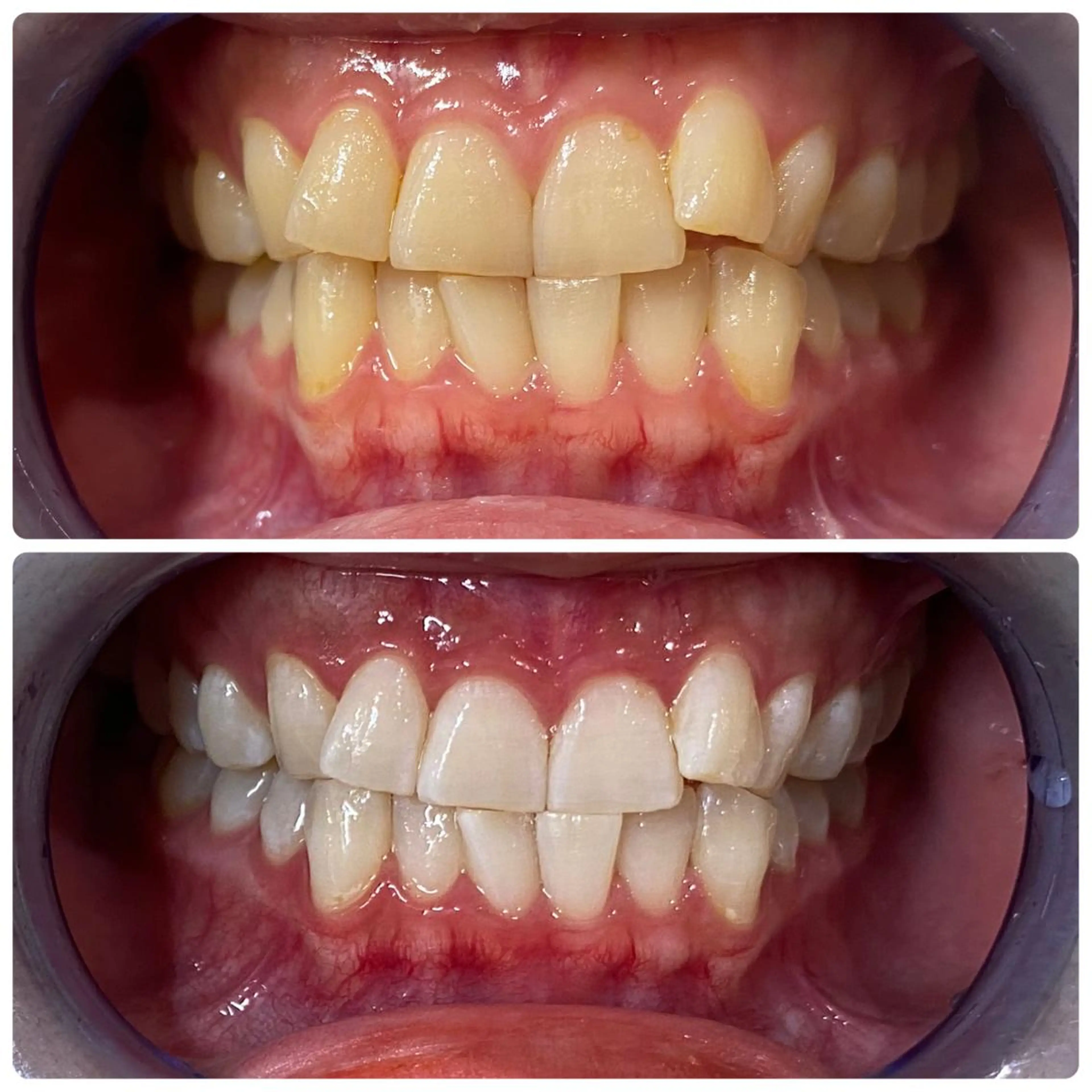 その他 セルフホワイトニング 🦷口元垢抜け✨のその他イメージ