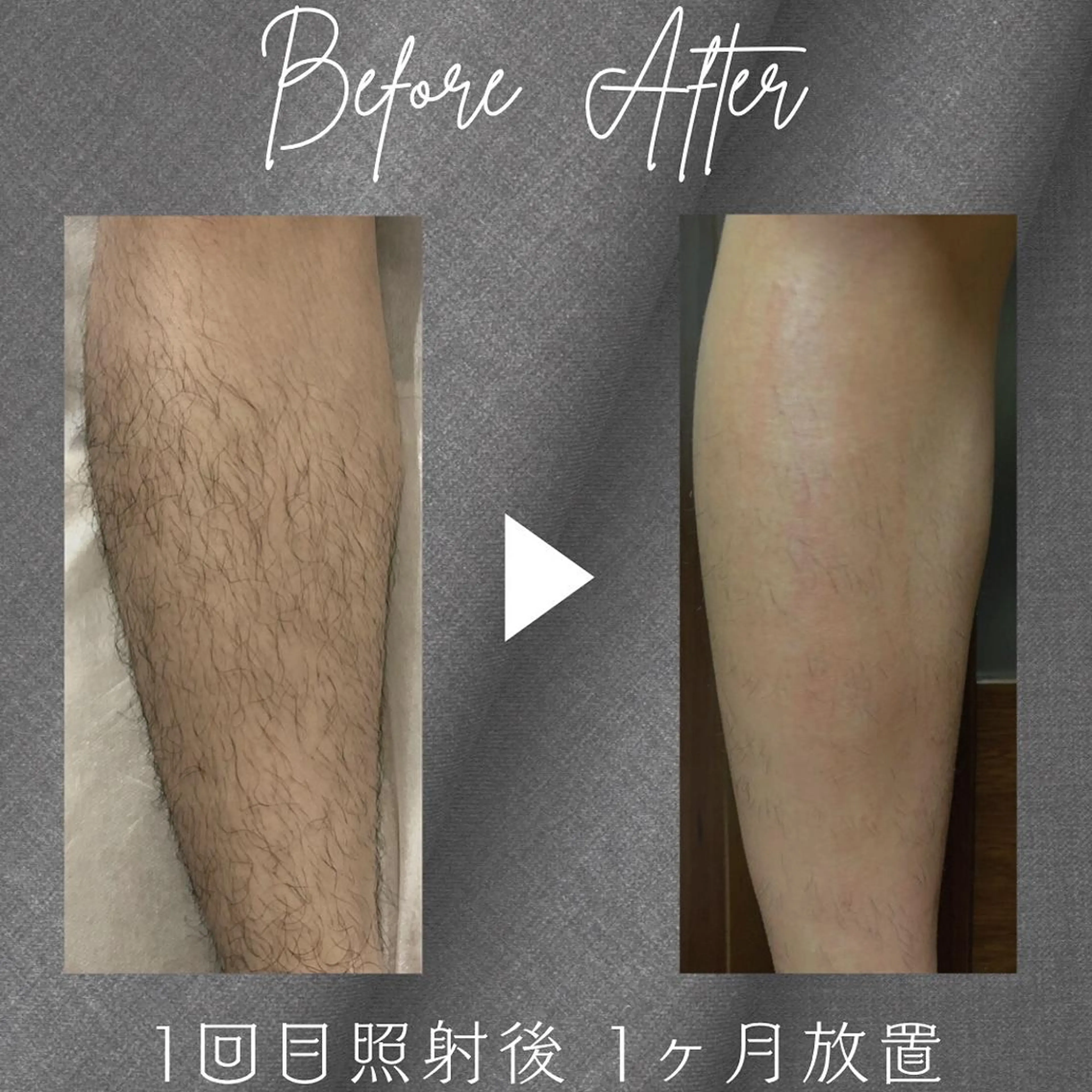 3部位セレクト脱毛/メンズの写真