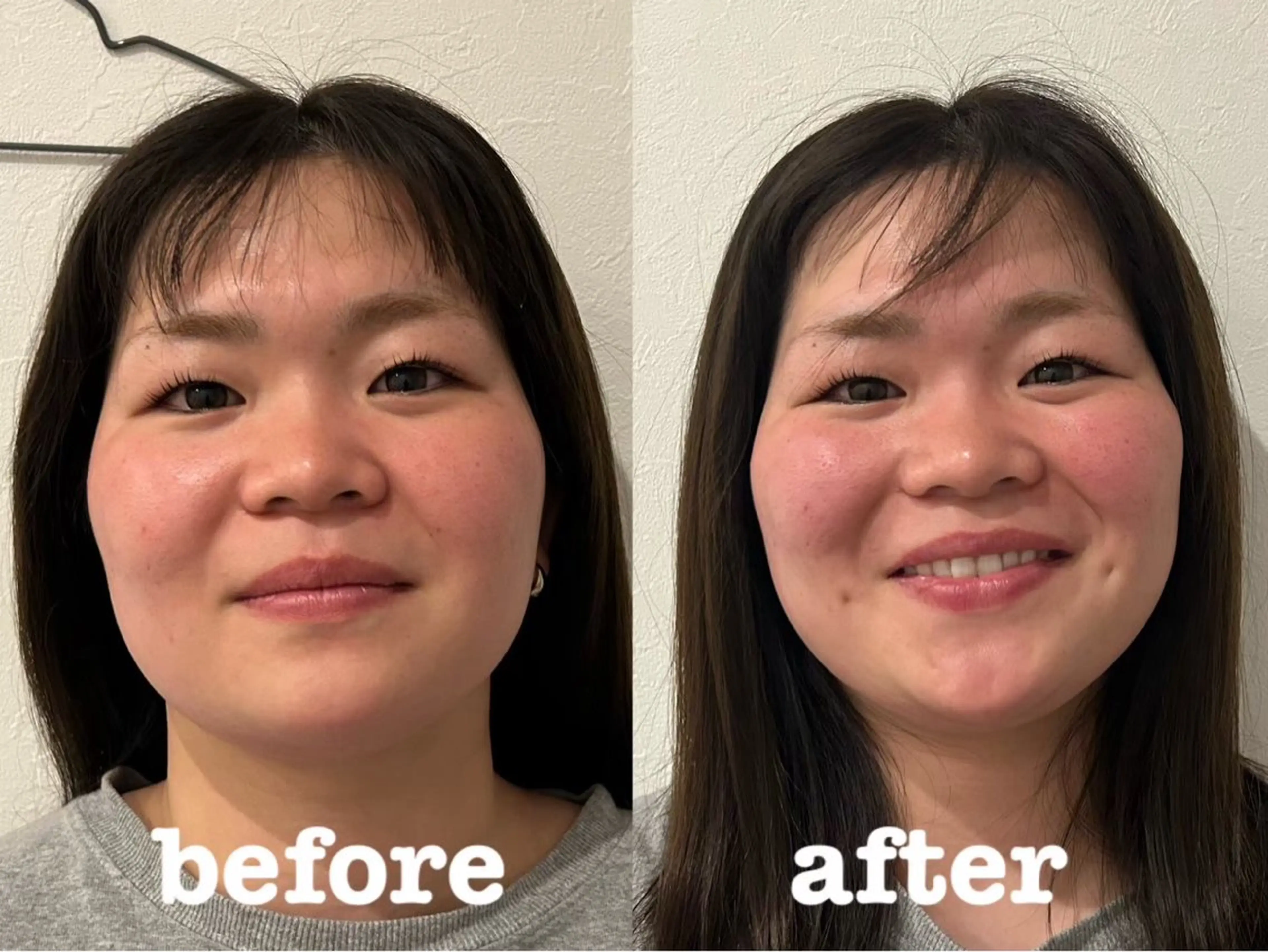 エステ リラク 美容鍼灸Solana所属・肌質改善×美容鍼 ゆいのエステ・リラクイメージ