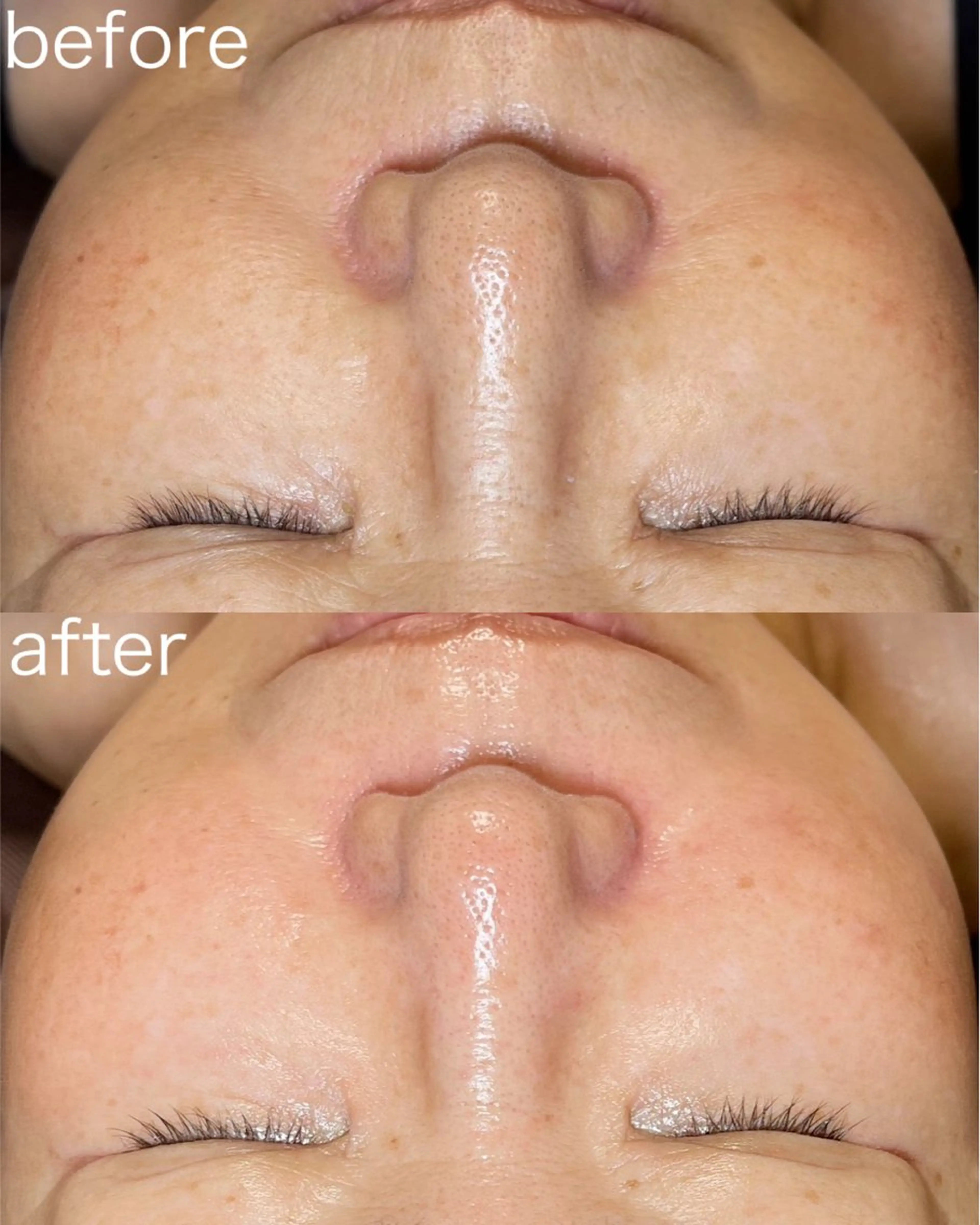 【毛穴特化コース】毛穴の黒ずみやザラつきが気になる方に✨フェイシャルマッサージ付の写真