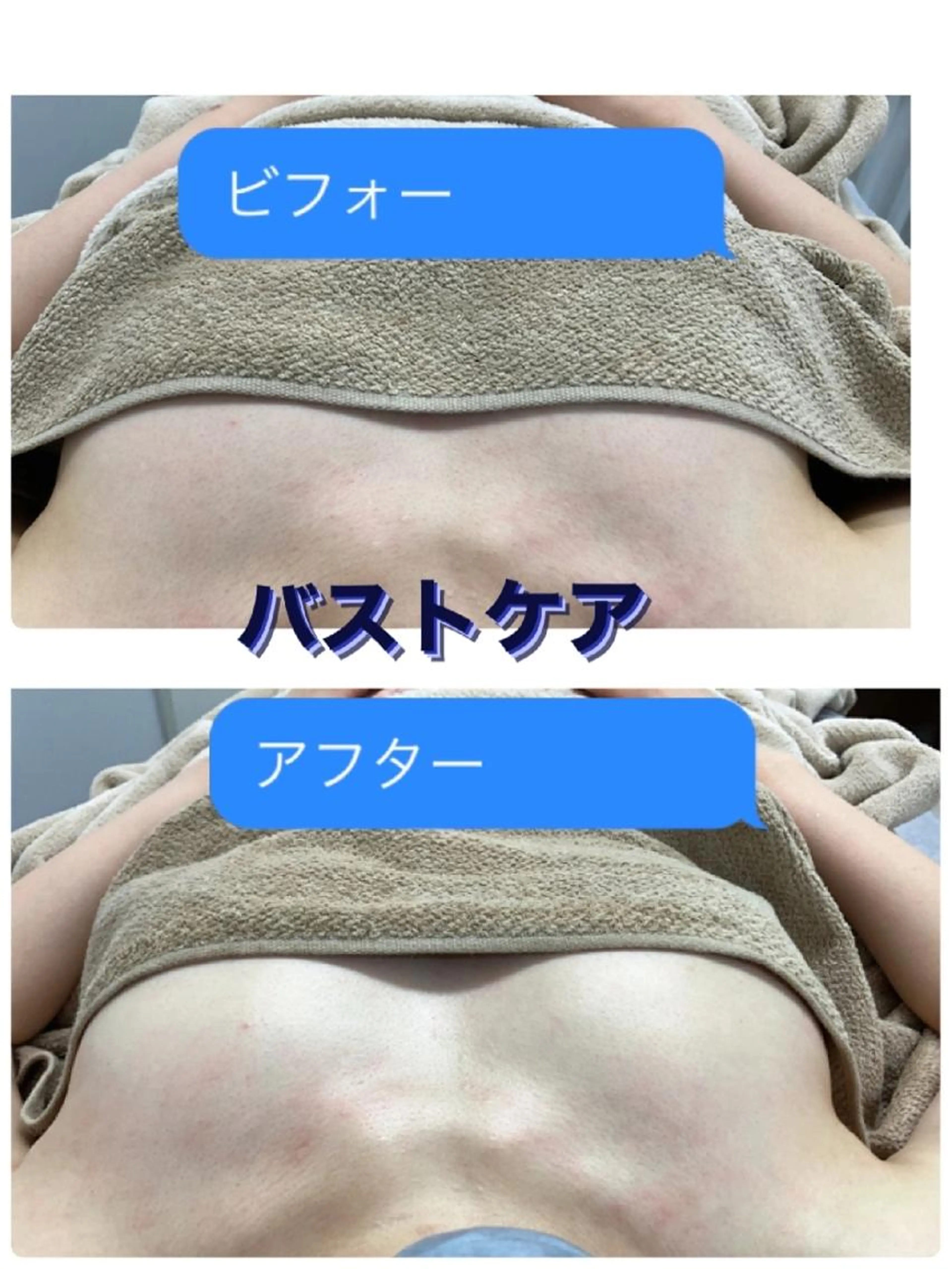 【背中スッキリ💖バストケア💗】40分　高周波でリンパ、バスト周りの脂肪にアプローチ＆光照射✨バストトップはカバー♥の写真