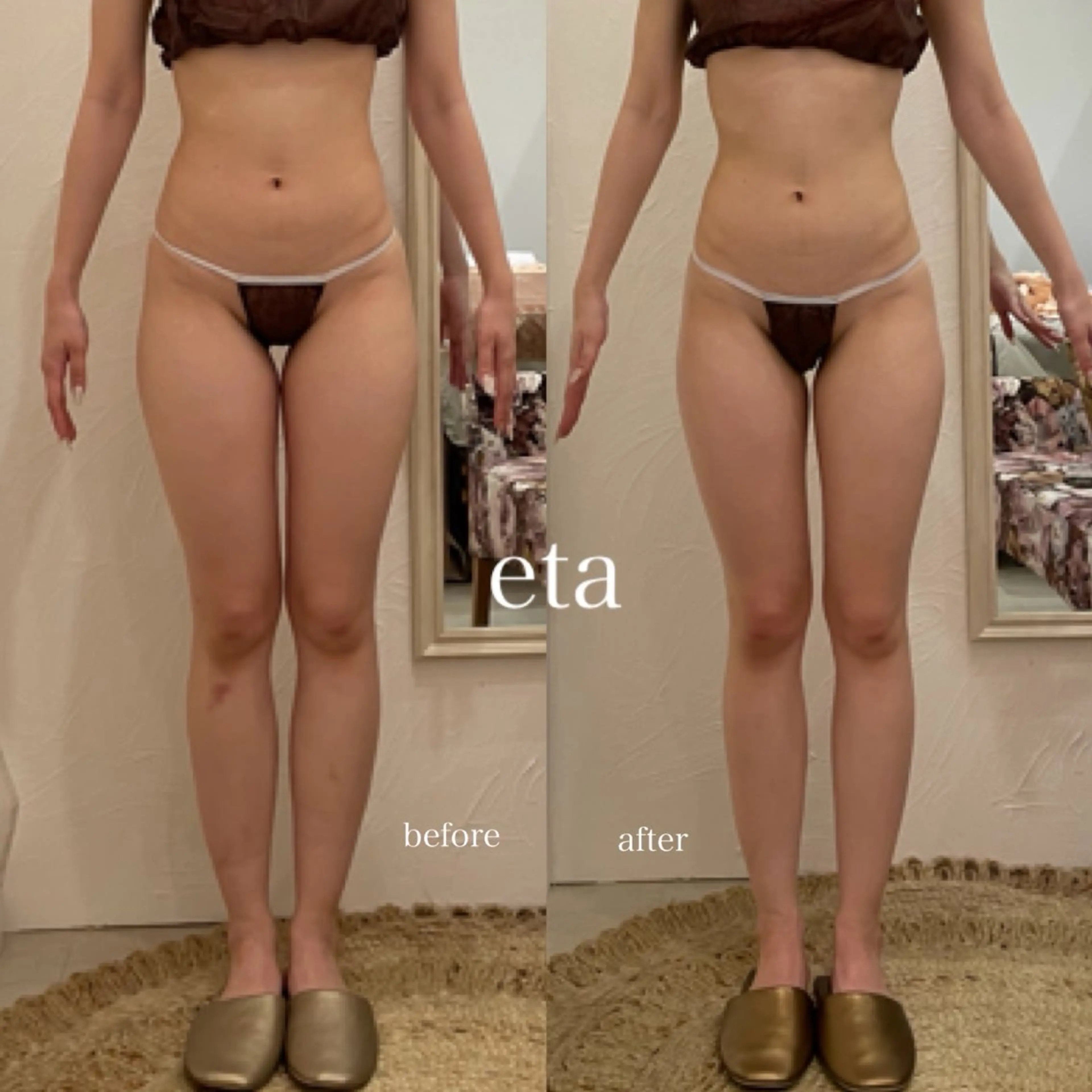 脚痩せ集中45分施術🥺🔥超高周波ラジオ波・キャビ・吸引🌸本気で変わりたい方向けクーポンの為遠方の方お断り🙇‍♀️の写真