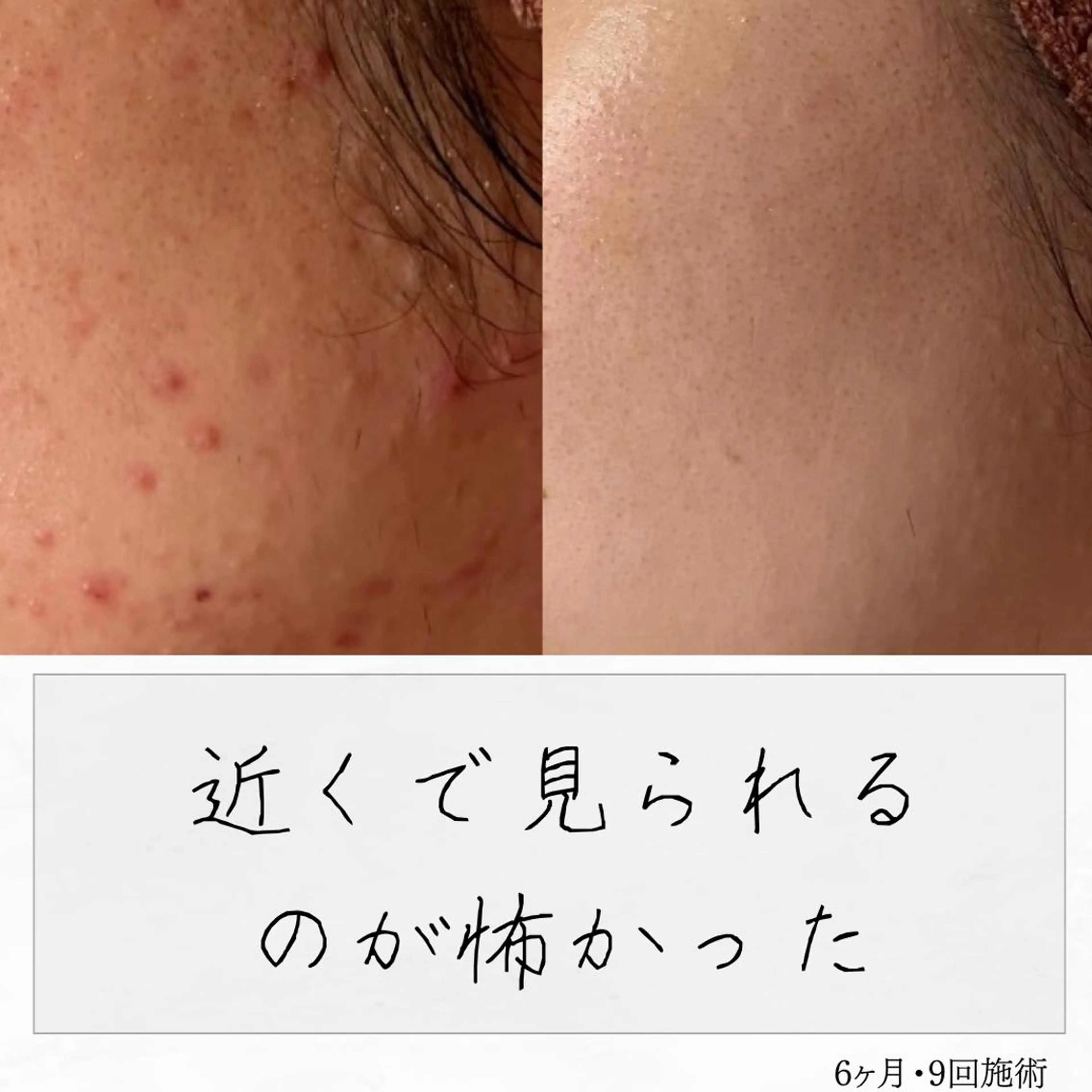 ニキビ経験者が施術 する専門サロン🌻のエステ・リラクイメージ