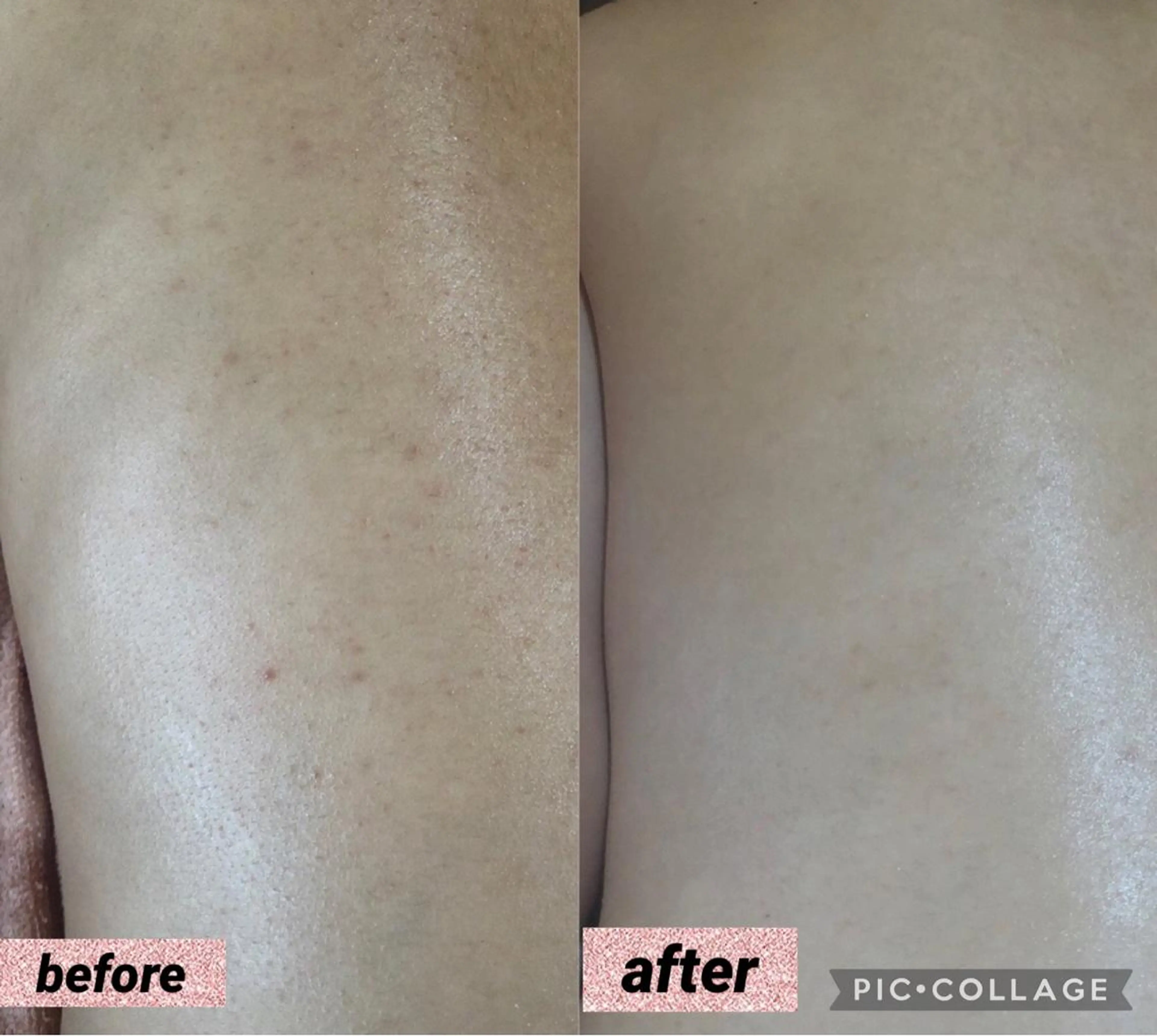 【REVI陶肌トリートメント】剥離無し　ハーブピーリング🌿陶肌トリートメント　『背中全面』4gの写真