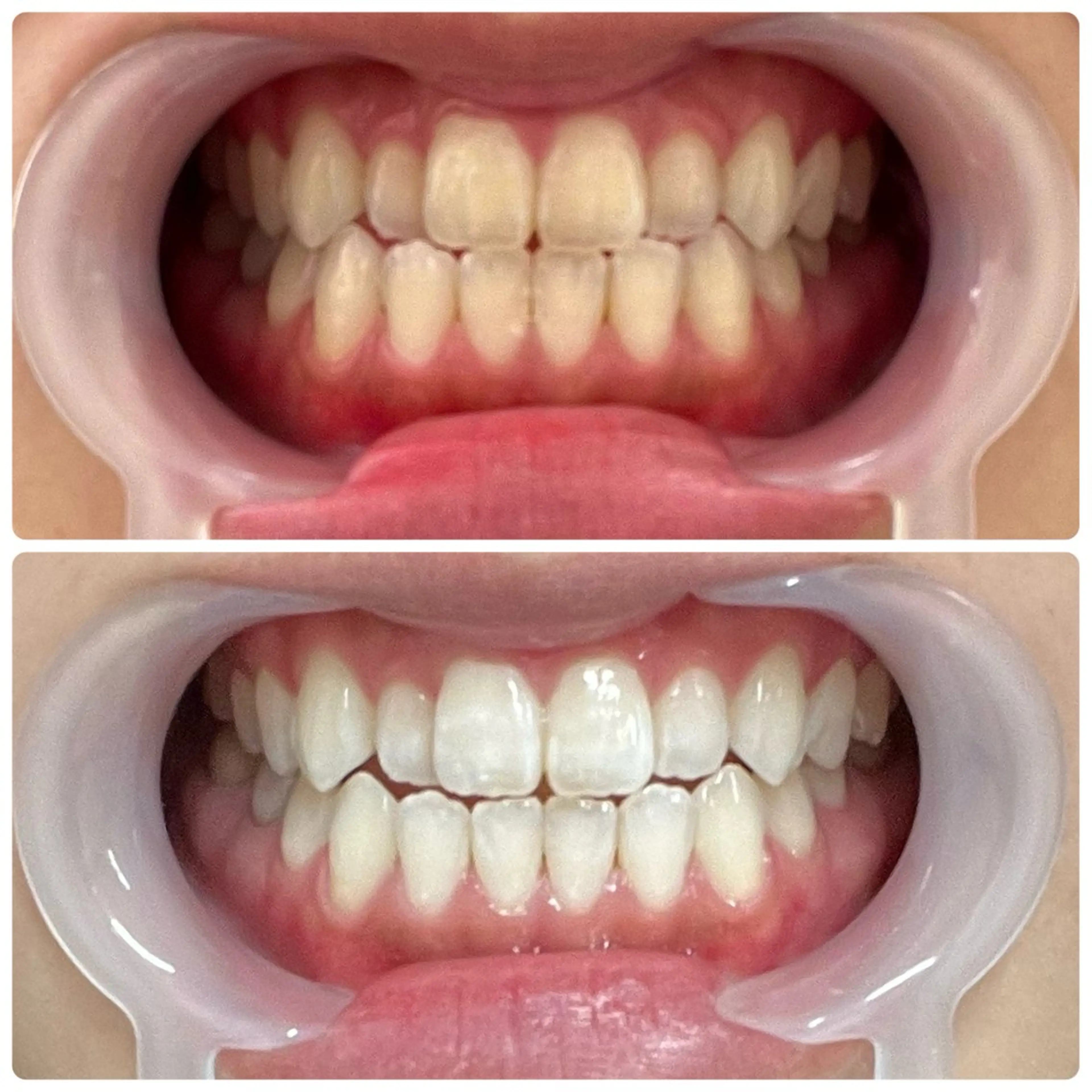 【初回】美容セルフホワイトニング 8分×3setの写真