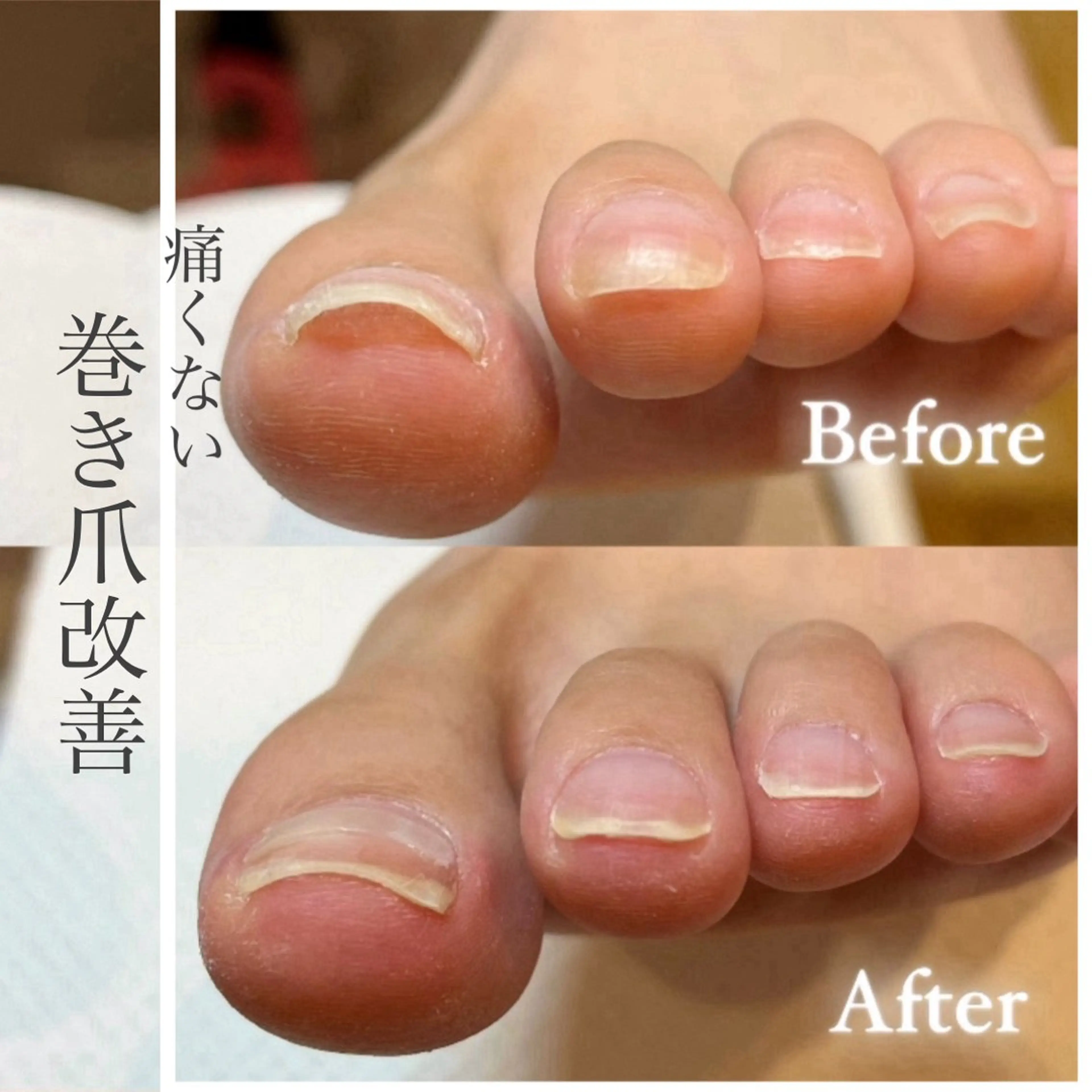 foot👣⸒⸒巻き爪改善(親指2本)の写真