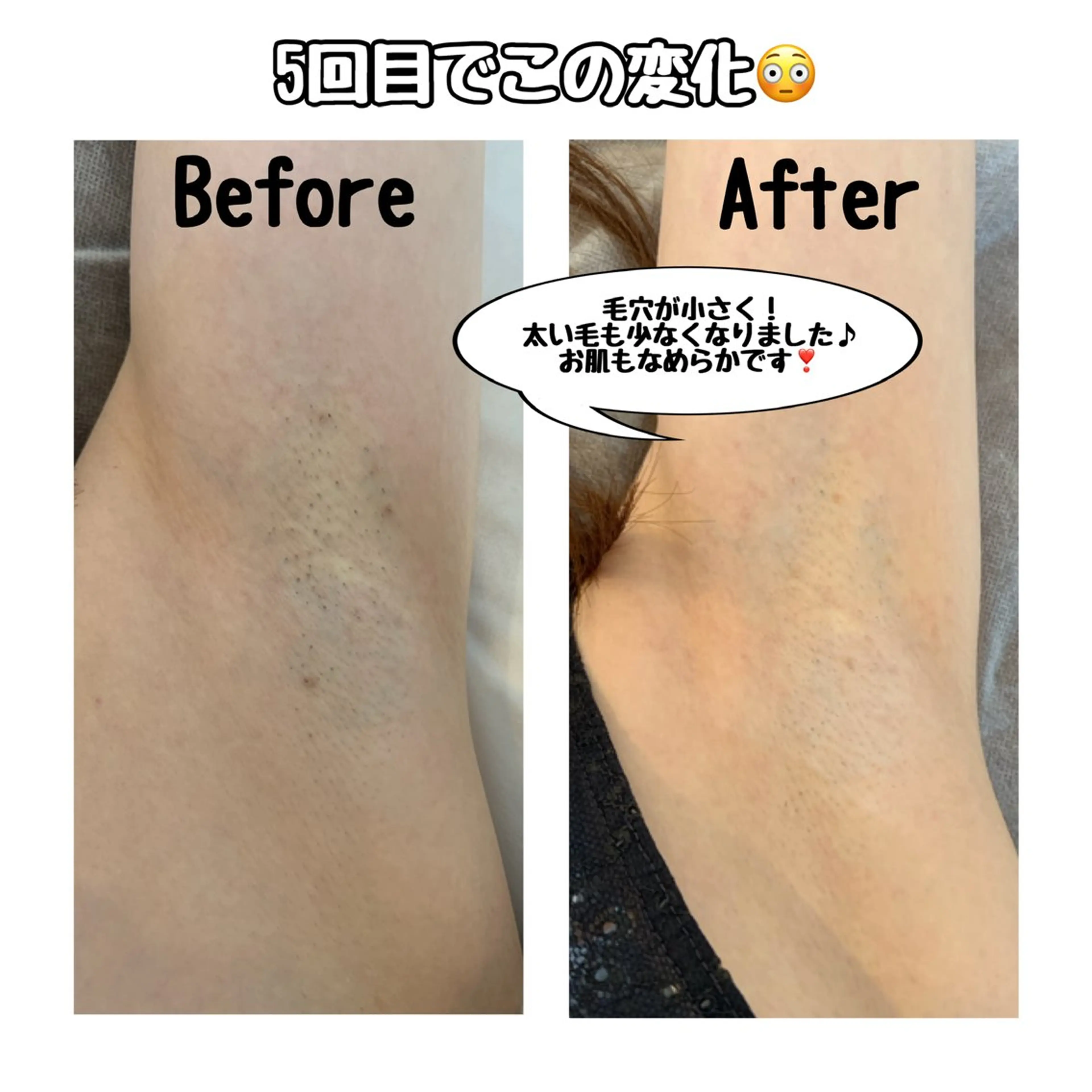 《新規》期間限定🎉特別価格🉐【ワキ脱毛¥550】施術はたったの5分⭐️ワキの匂い＆ムレや黒ずみ＆毛穴も改善♪の写真