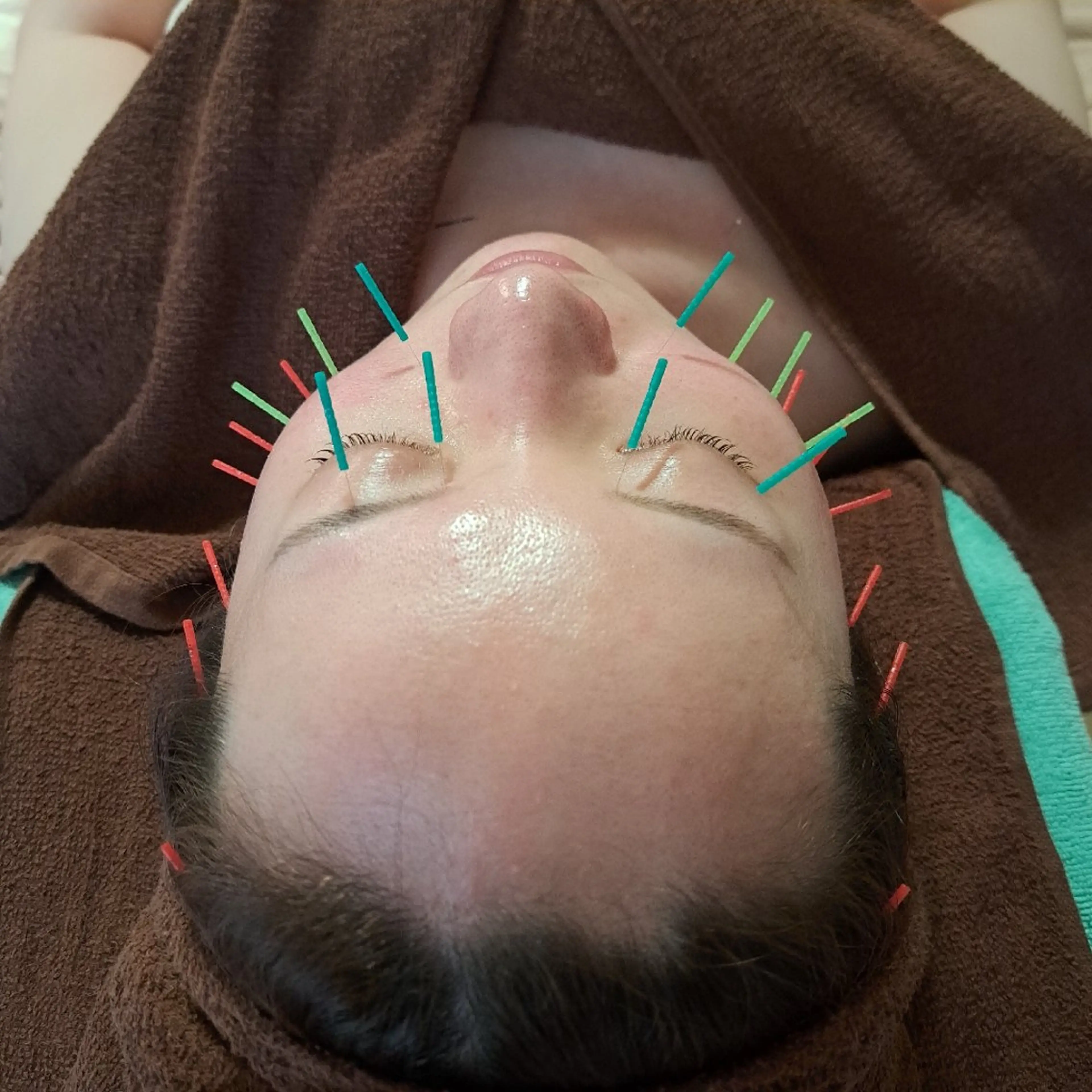 鍼灸サロンmiyabi所属・美容鍼×エステ 鍼灸 サロンmiyabiのエステ・リラクイメージ