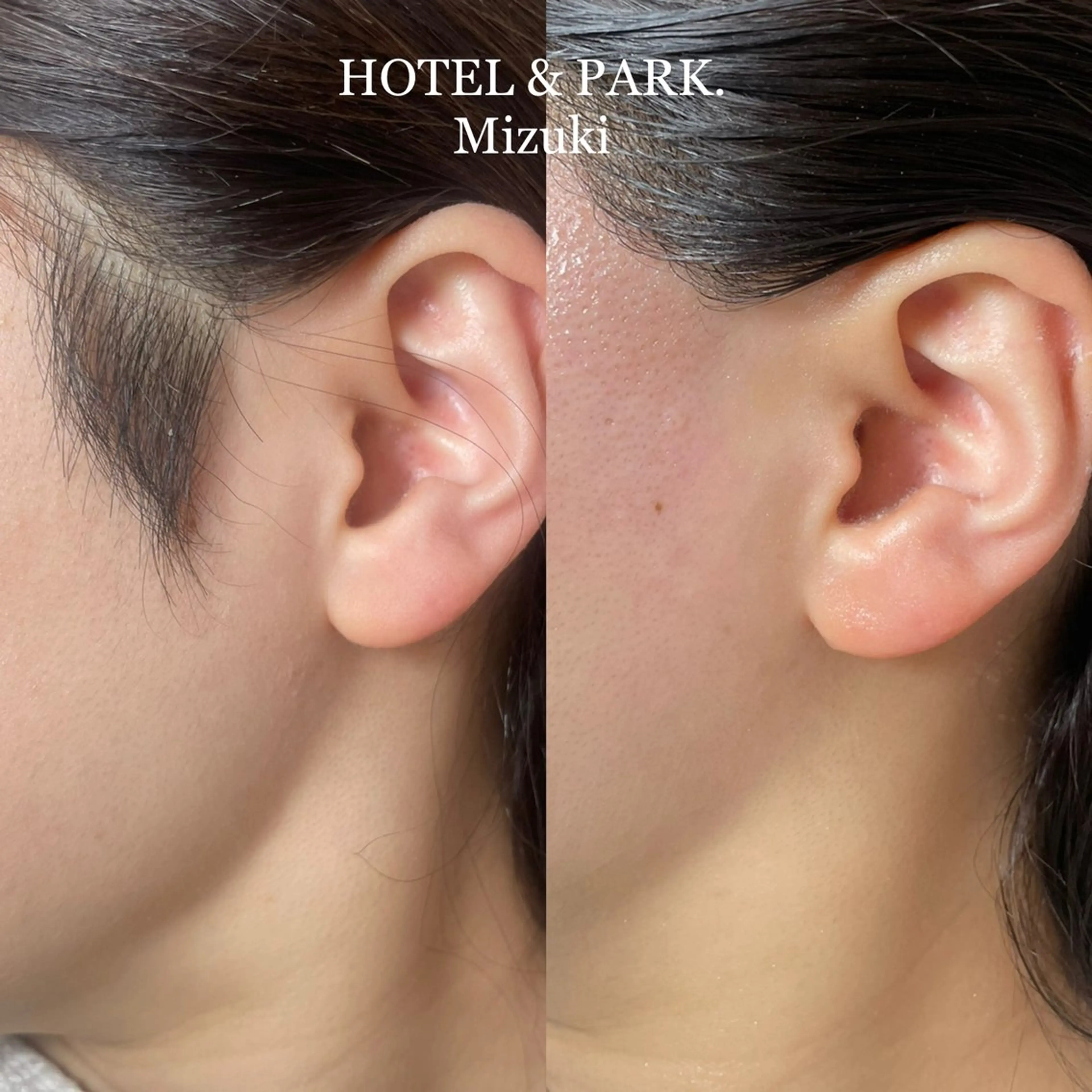 脱毛 HOTEL&PARK . ワックス脱毛のエステ・リラクイメージ